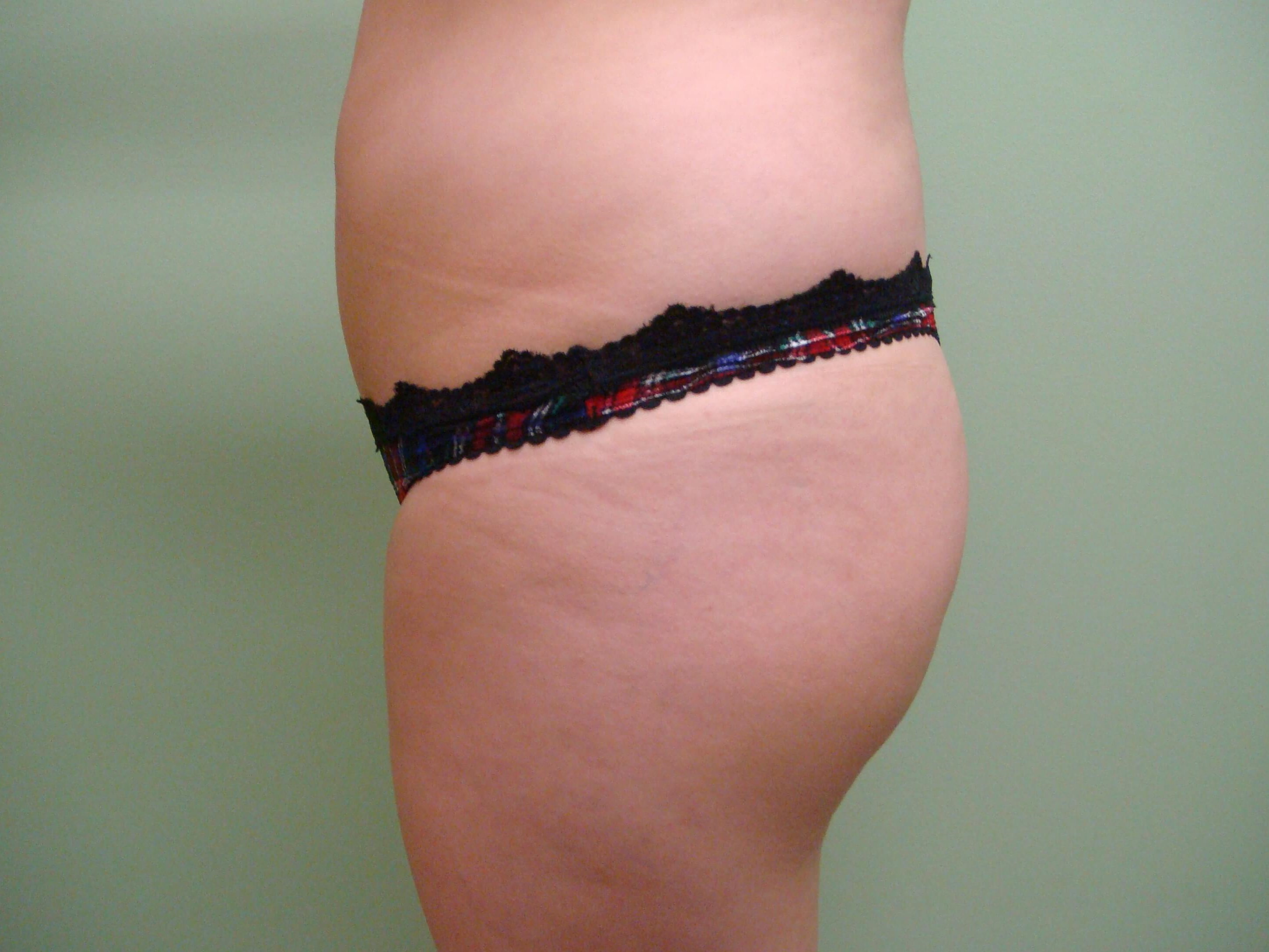 Buttock Augmentation Before