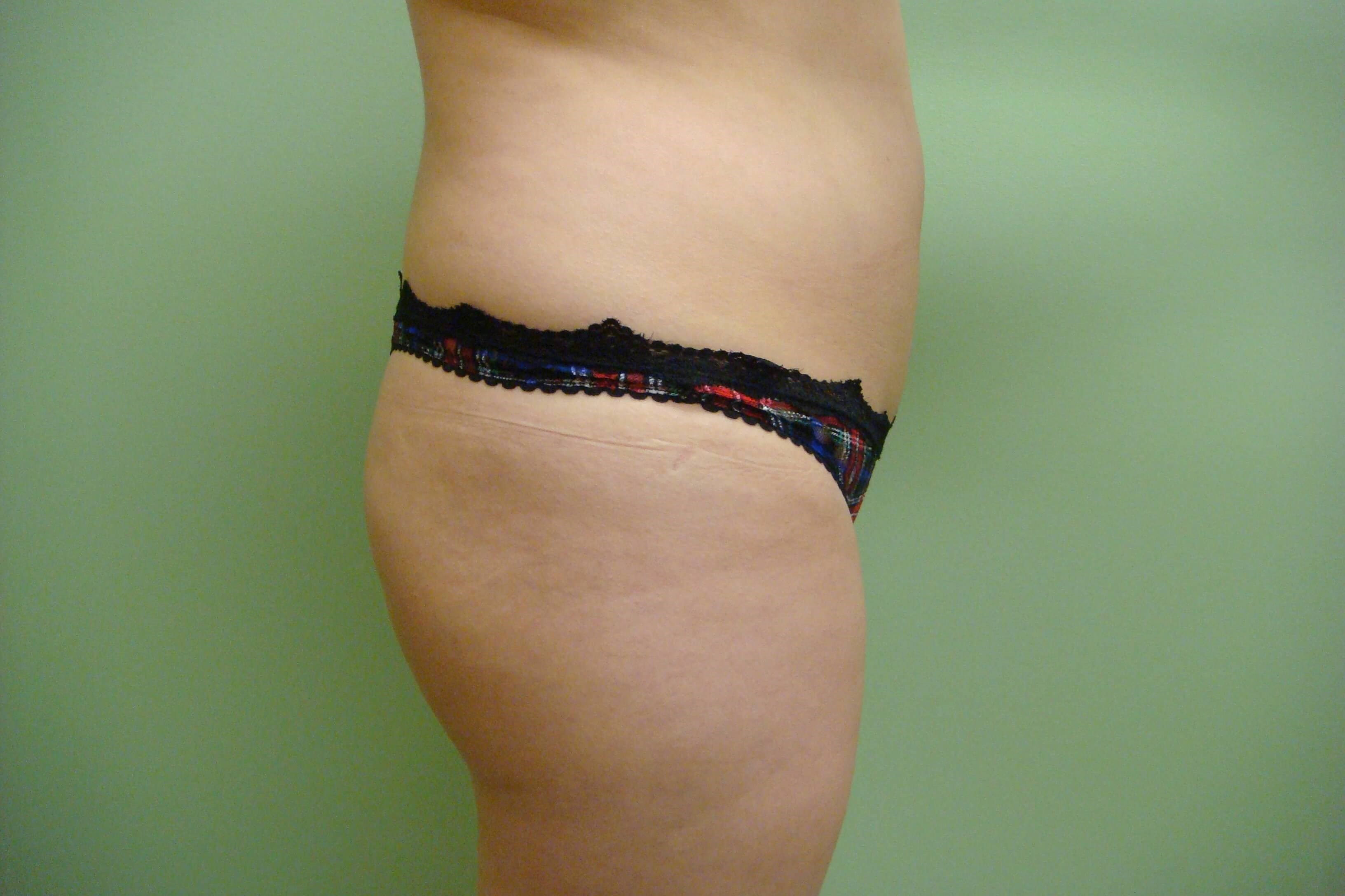 Buttock Augmentation Before