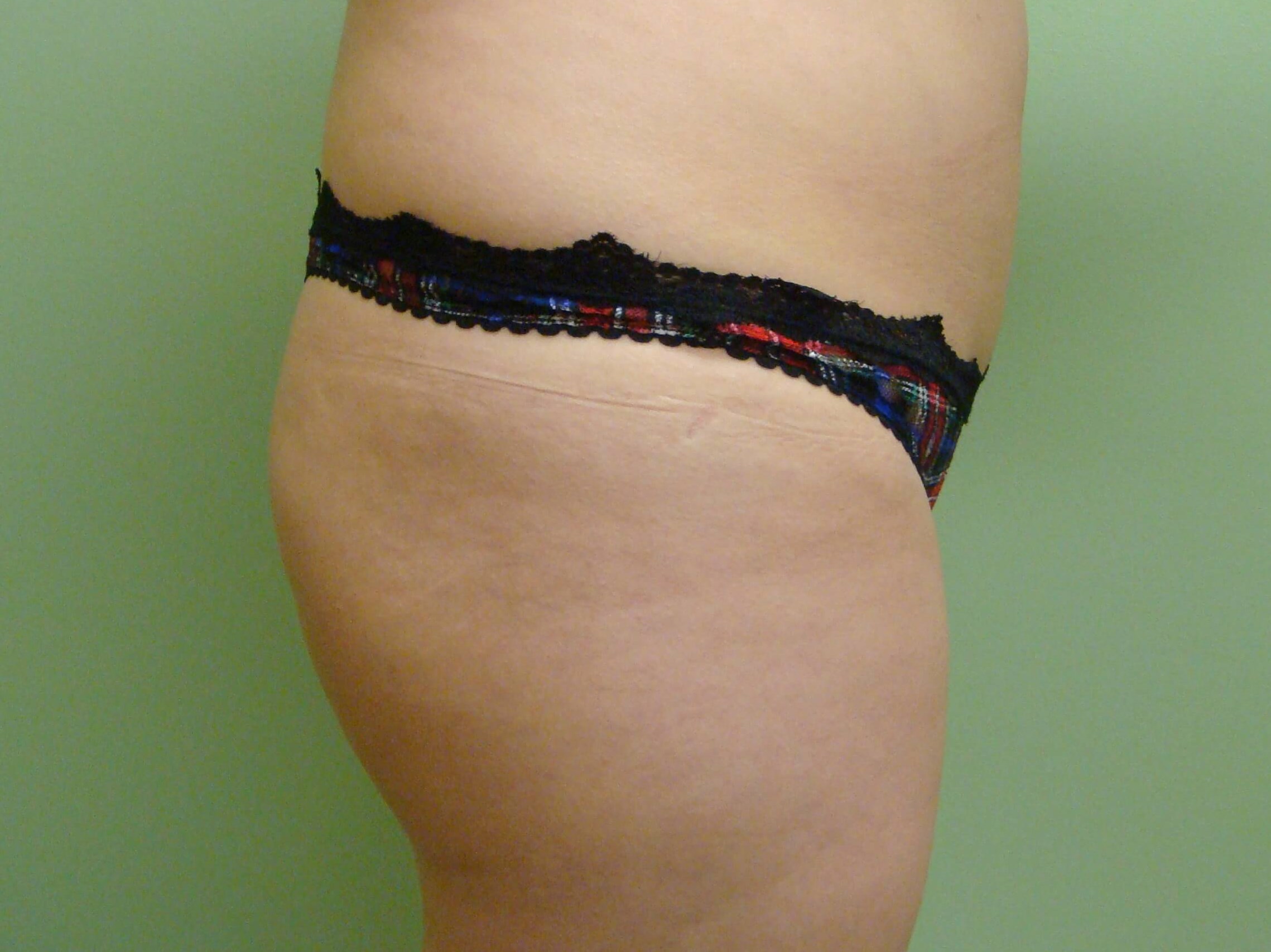 Buttock Augmentation Before