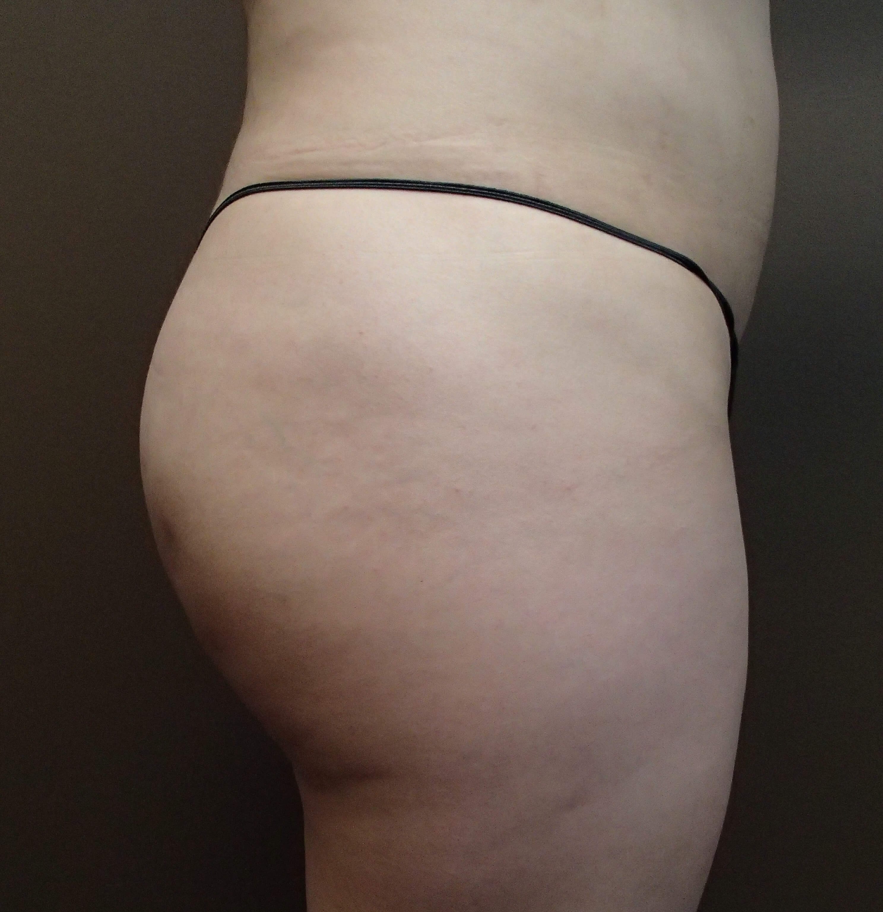 Buttock Augmentation After
