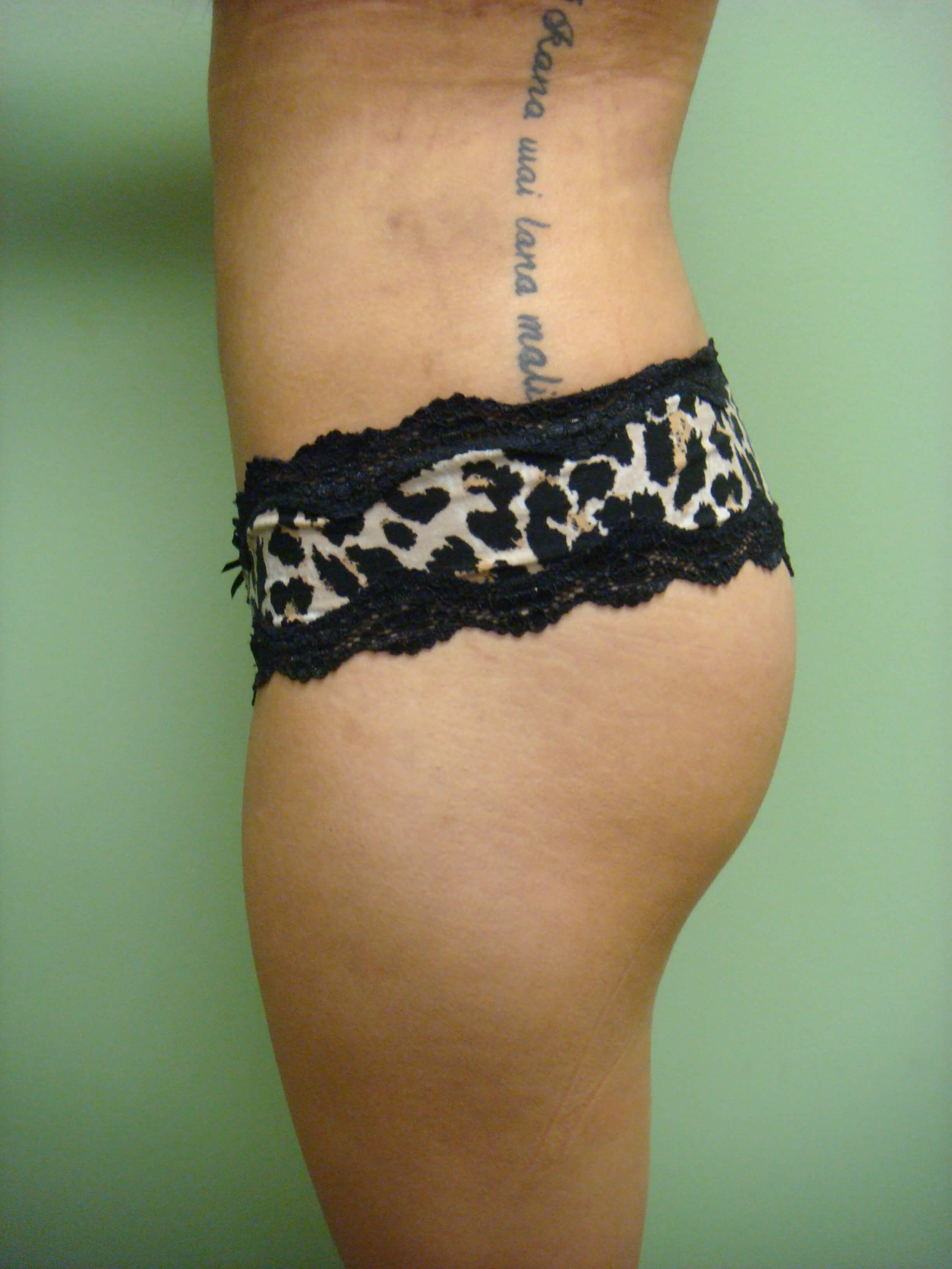 Buttock Augmentation After