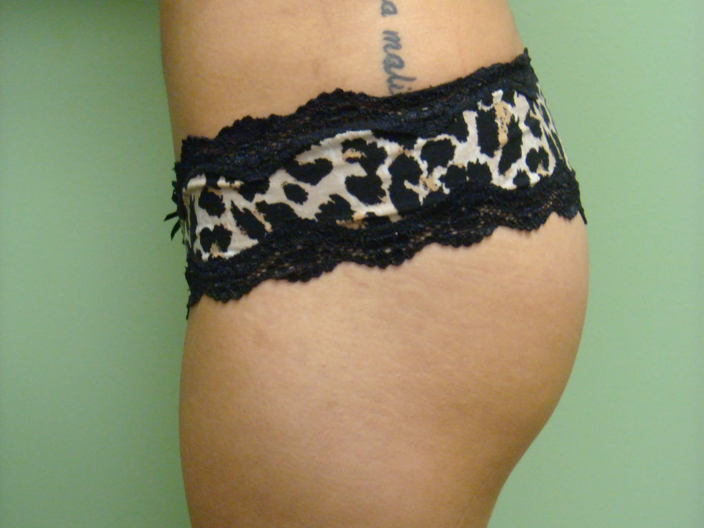 Buttock Augmentation After