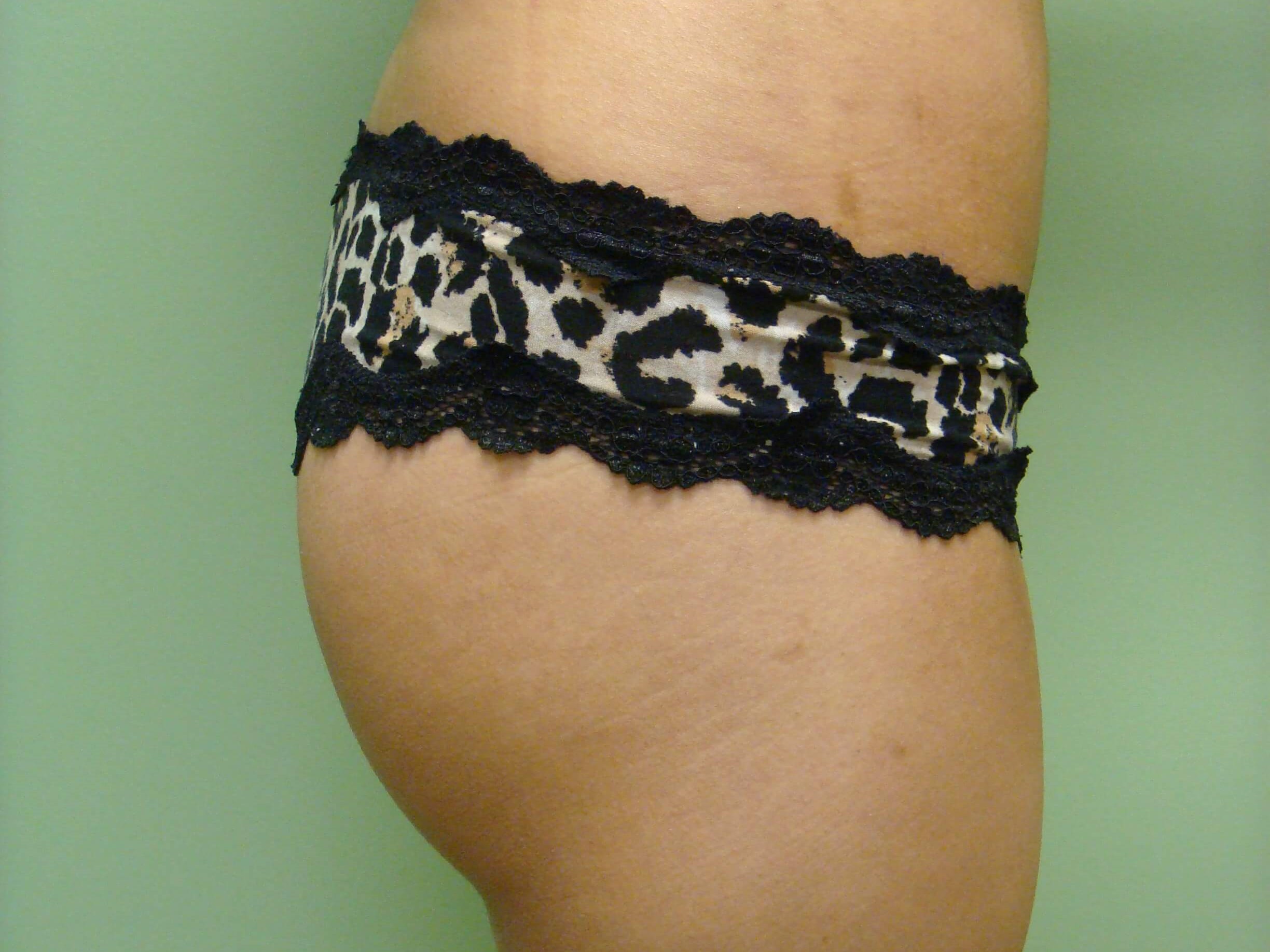 Buttock Augmentation After