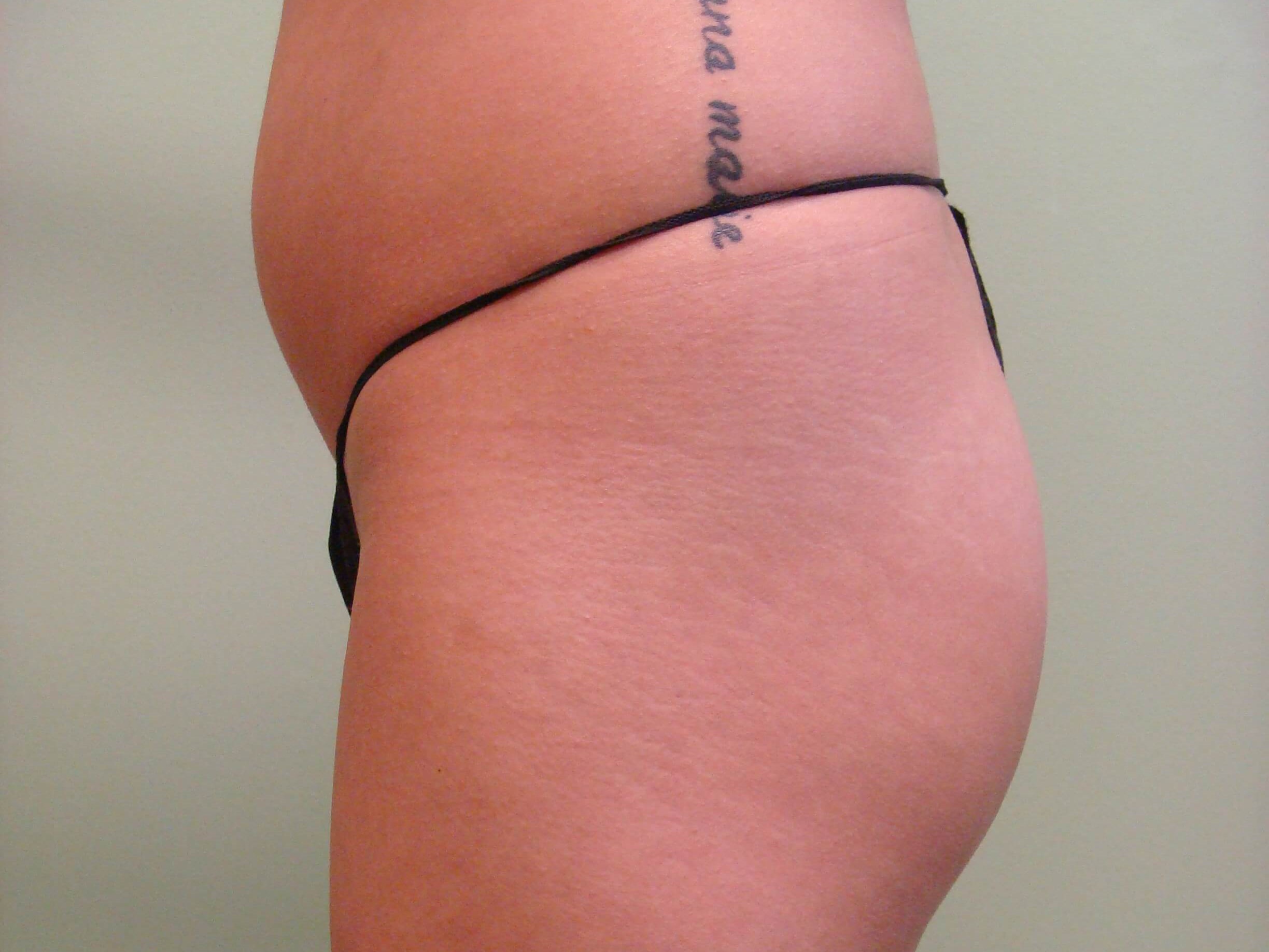 Buttock Augmentation Before