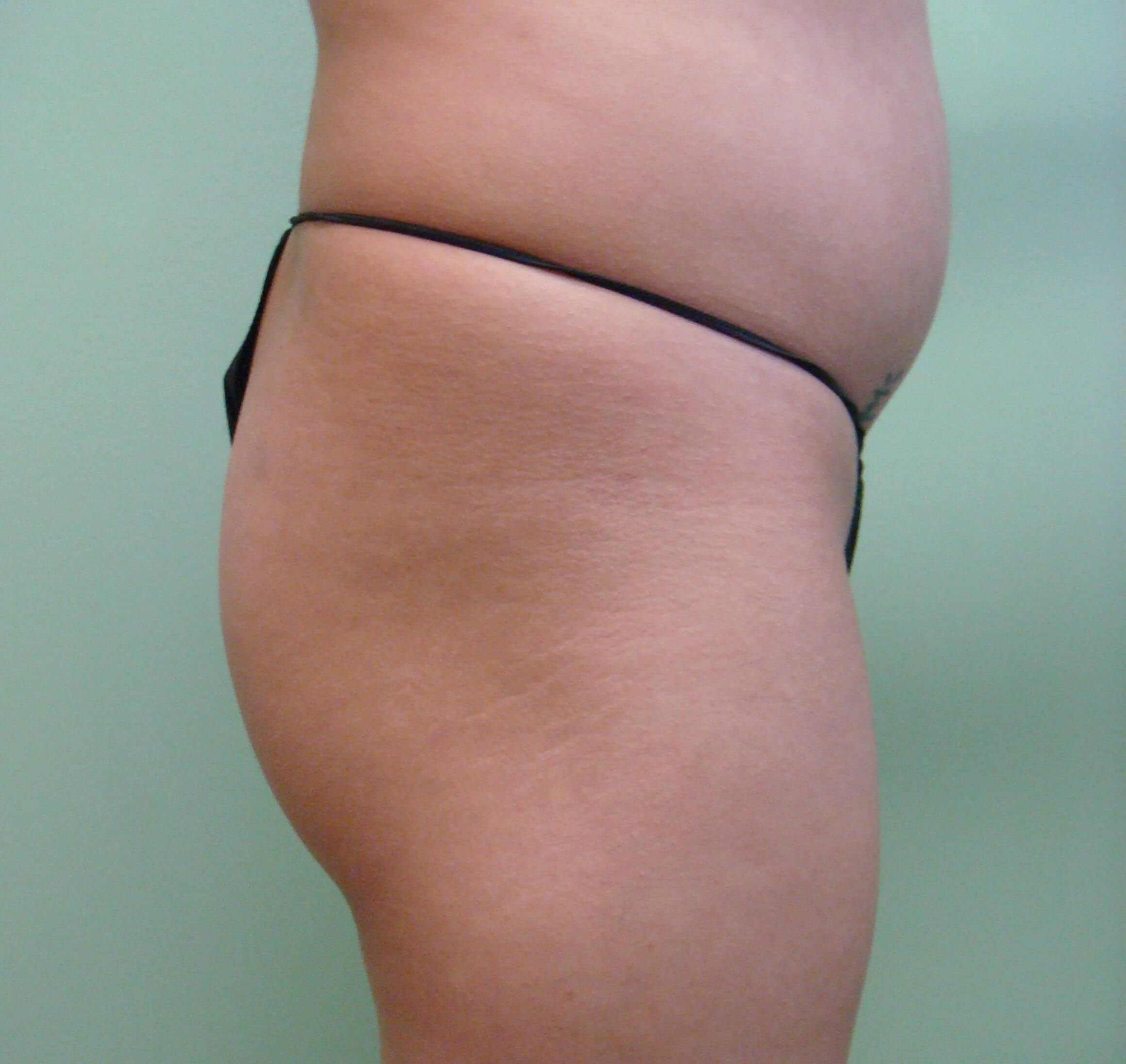 Buttock Augmentation Before