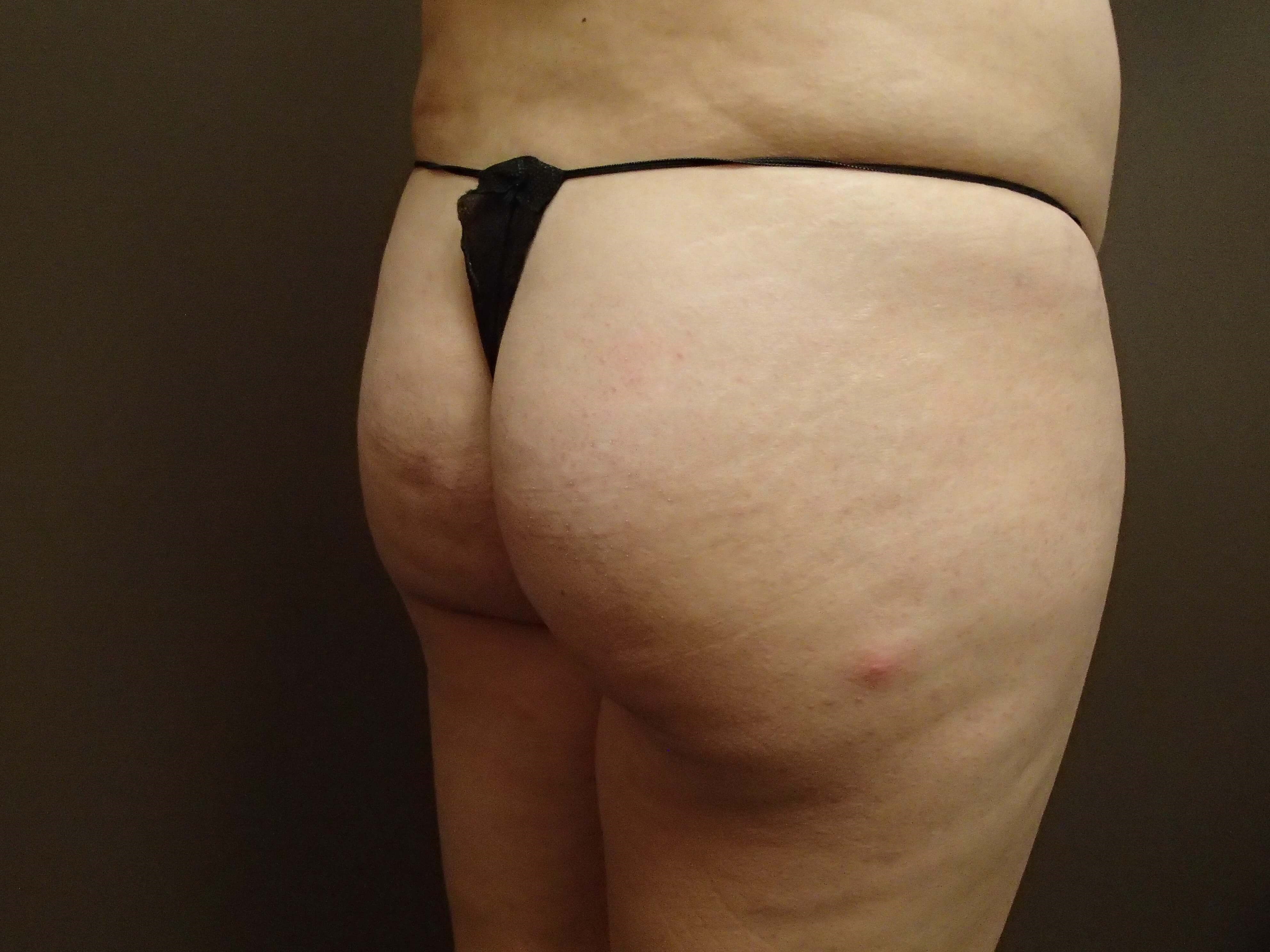 Buttock Augmentation Before