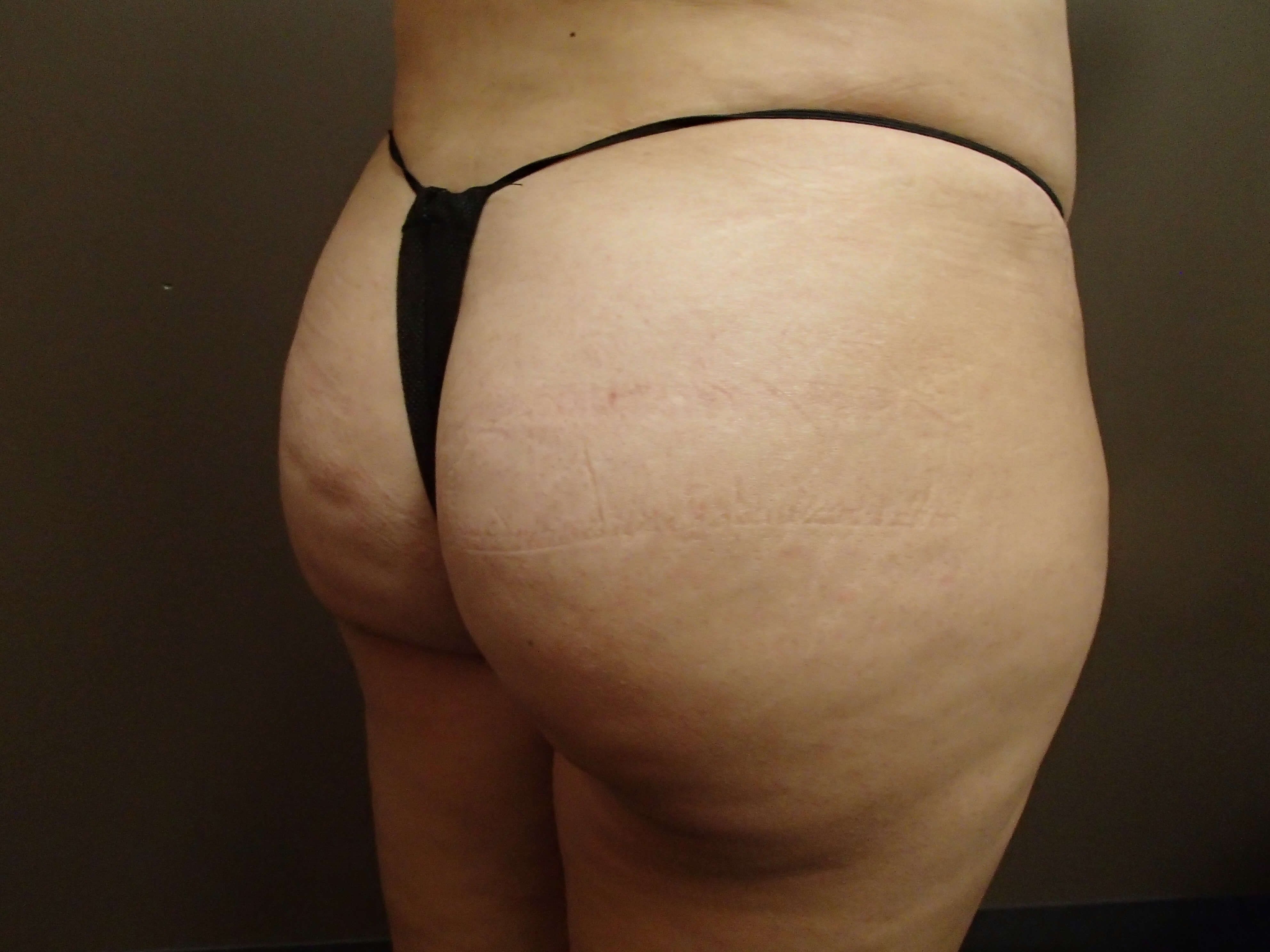 Buttock Augmentation After
