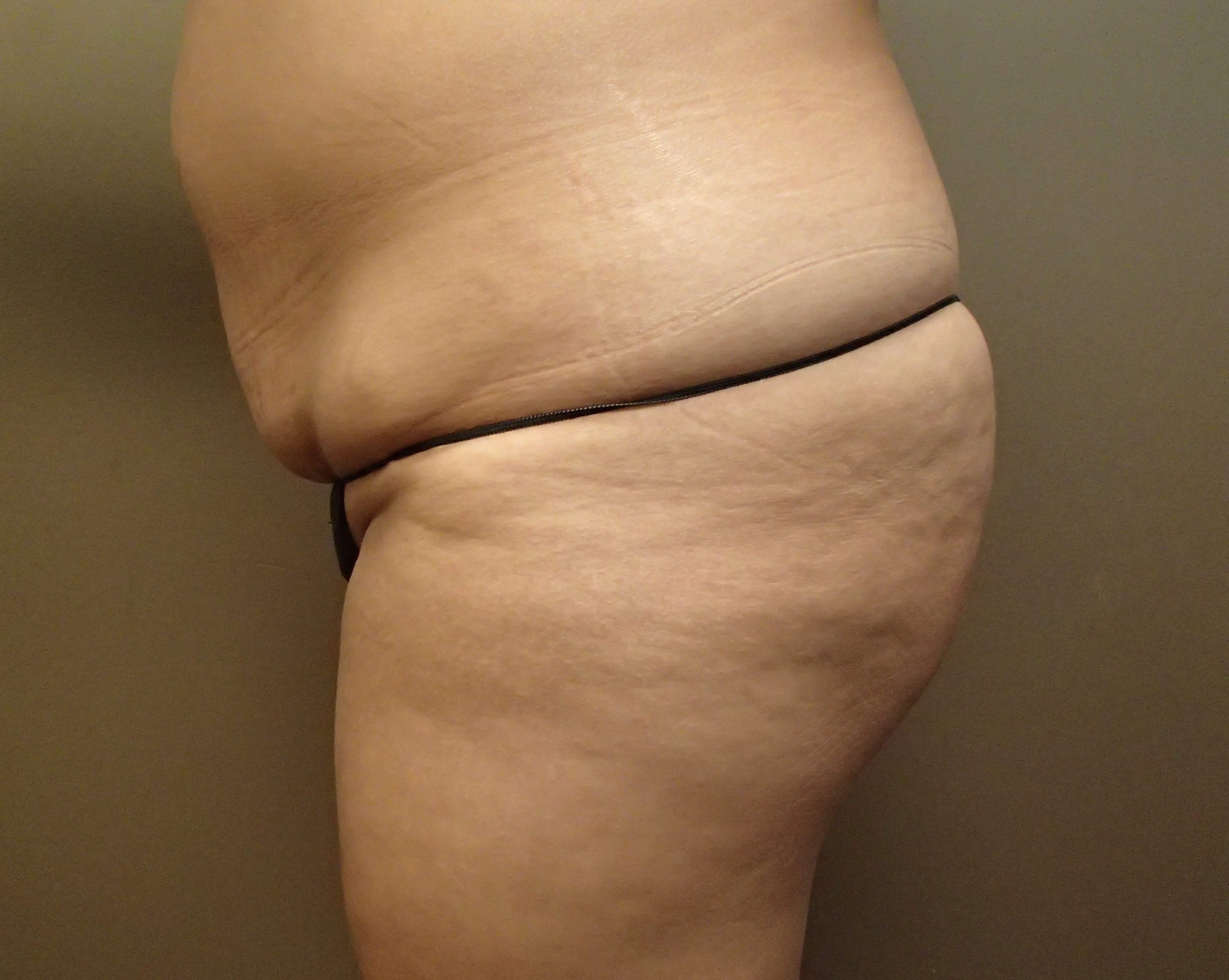 Buttock Augmentation Before