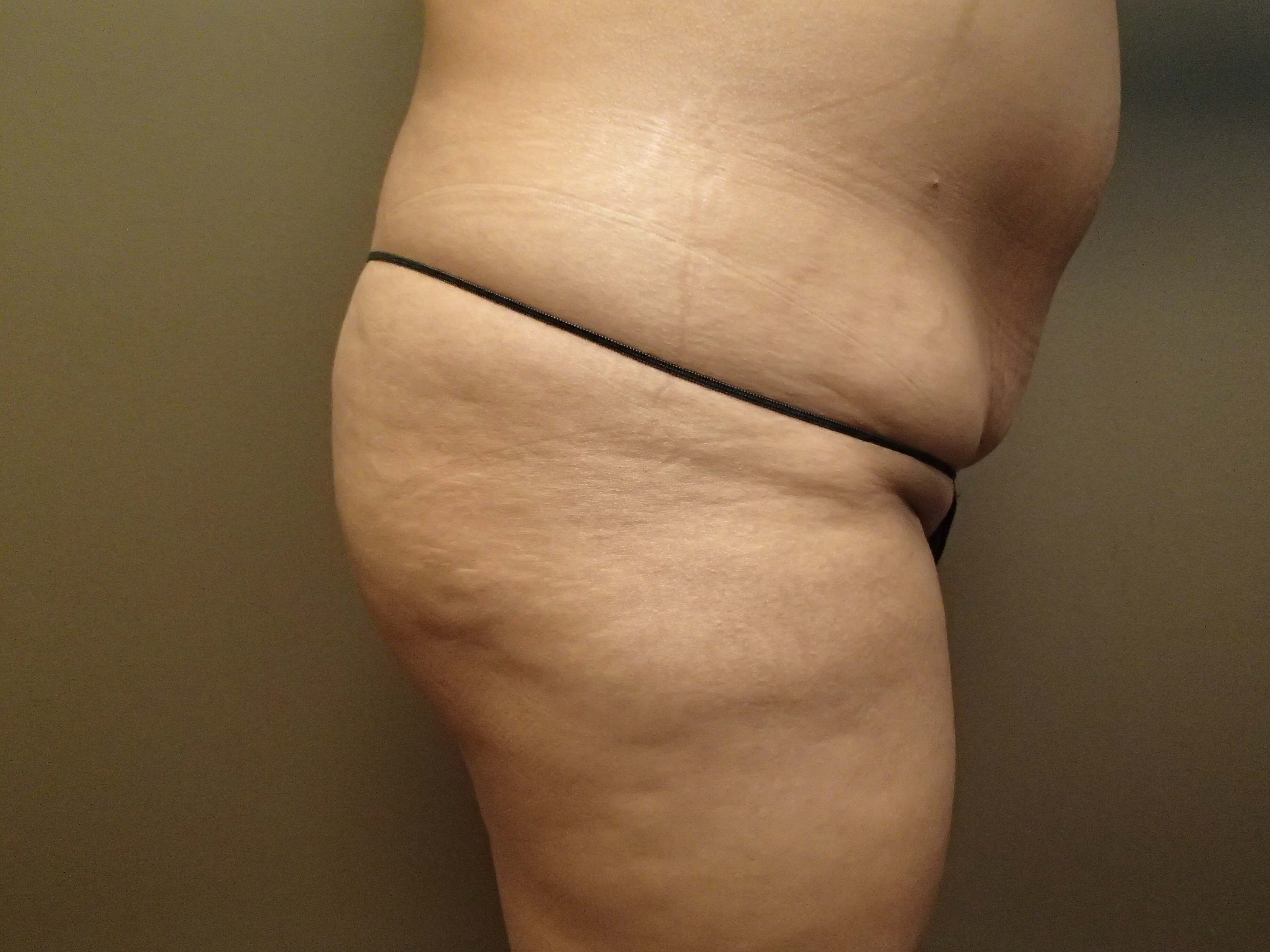Buttock Augmentation Before
