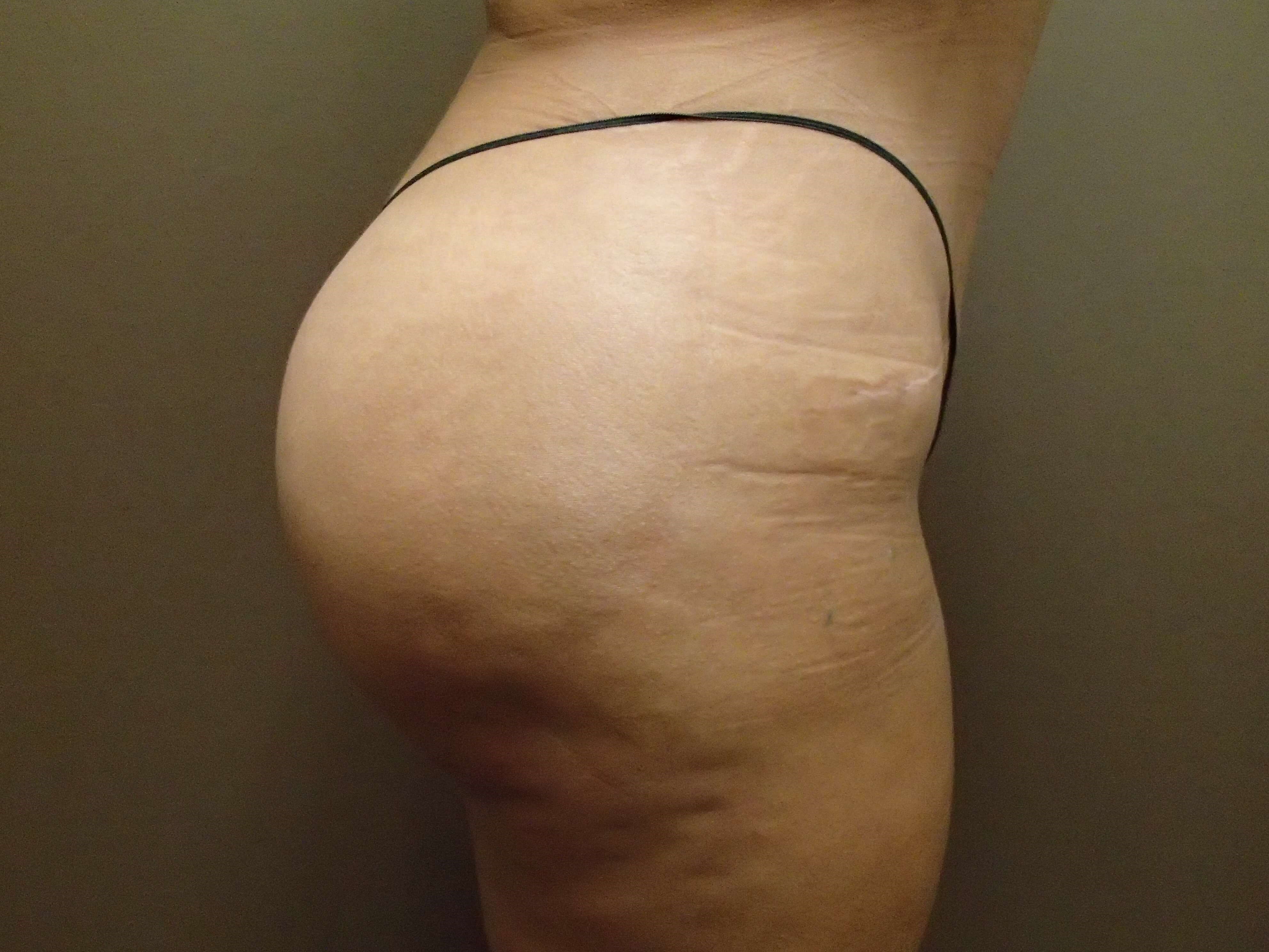 Buttock Augmentation After