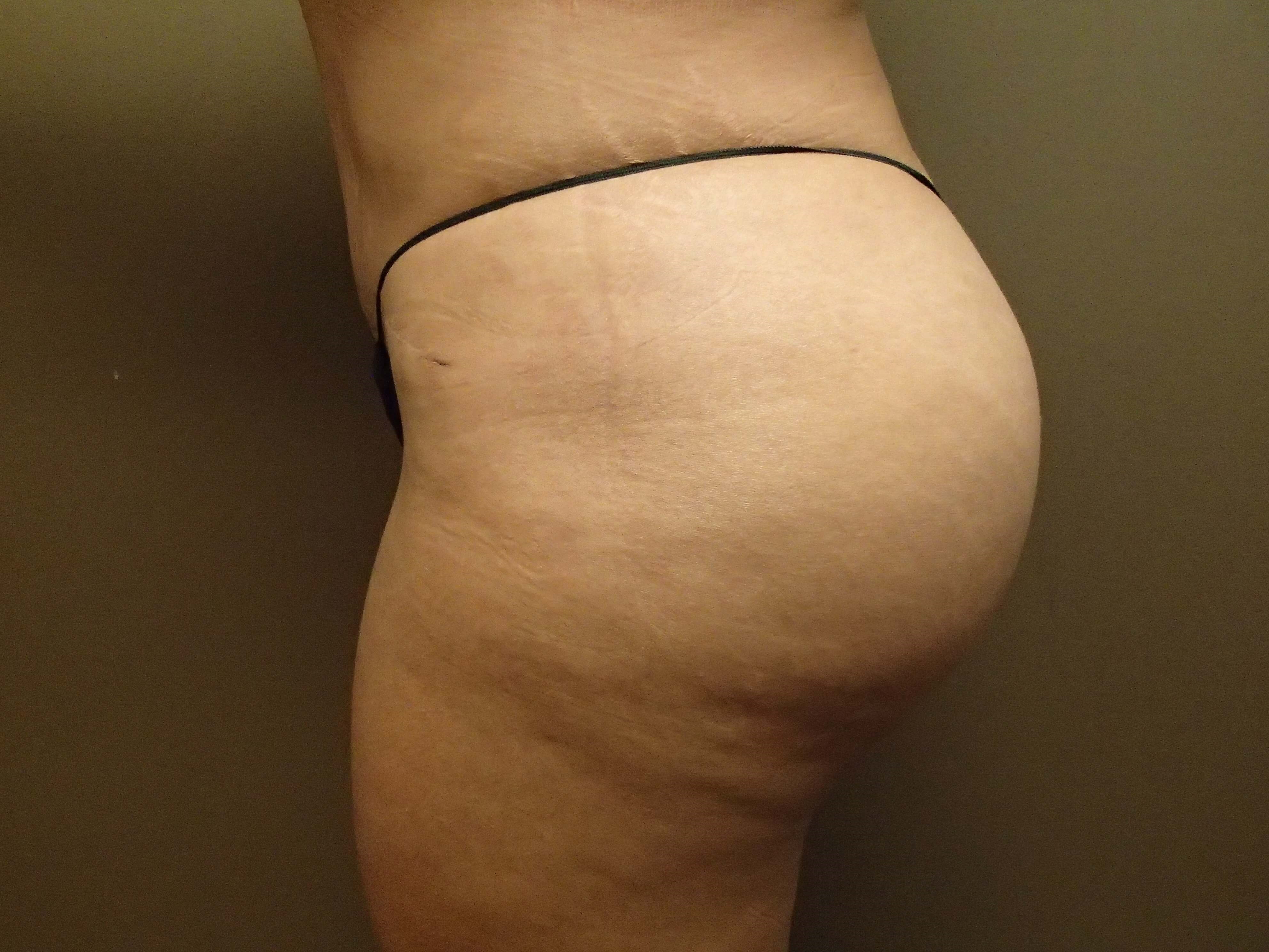 Buttock Augmentation After