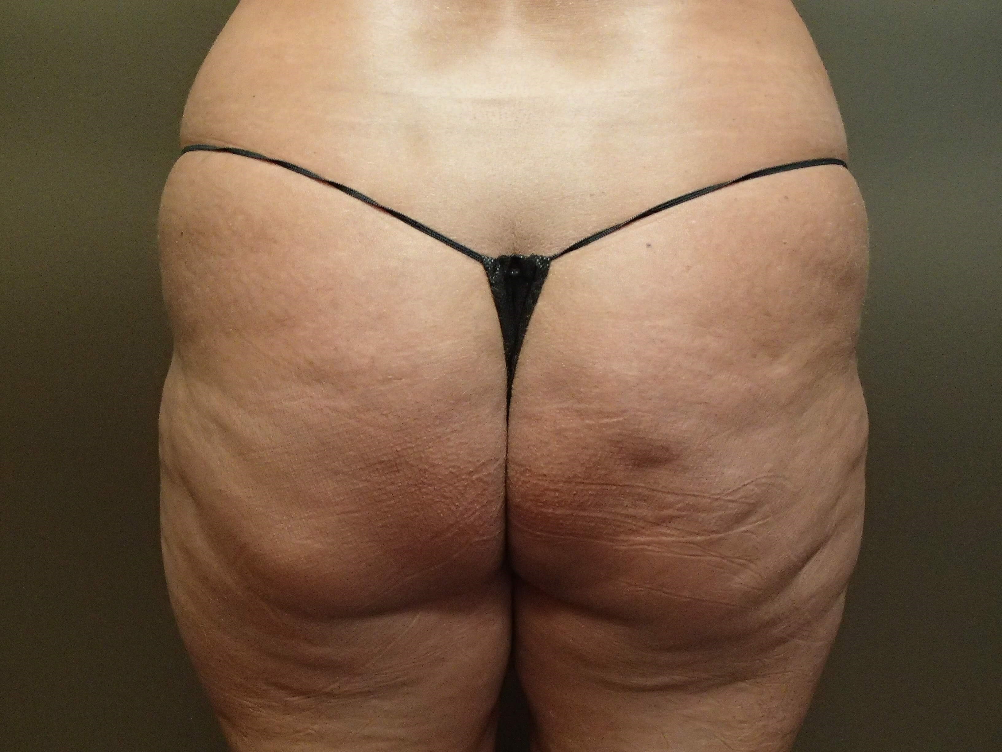 Buttock Augmentation Before