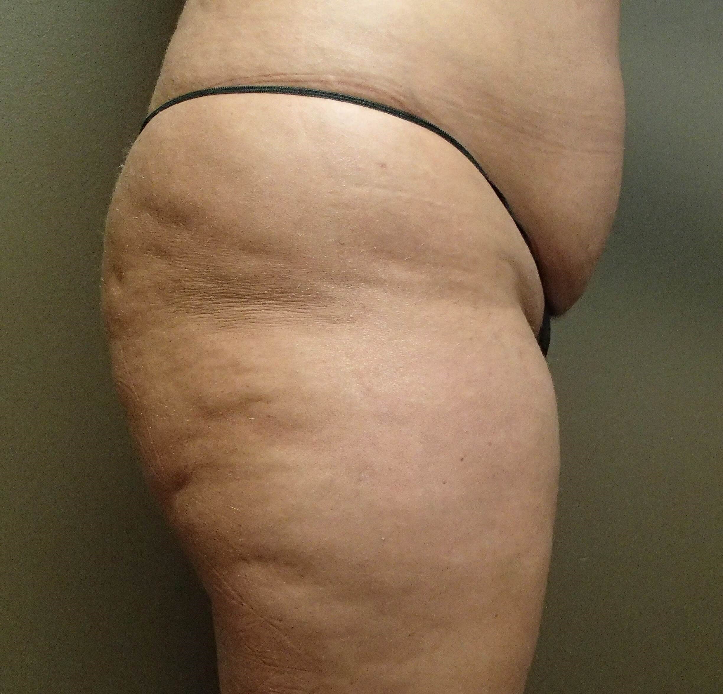 Buttock Augmentation Before
