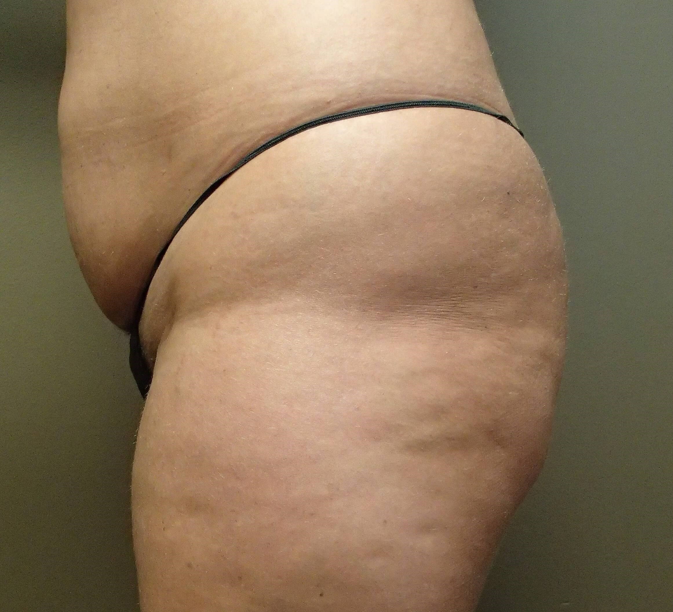 Buttock Augmentation Before
