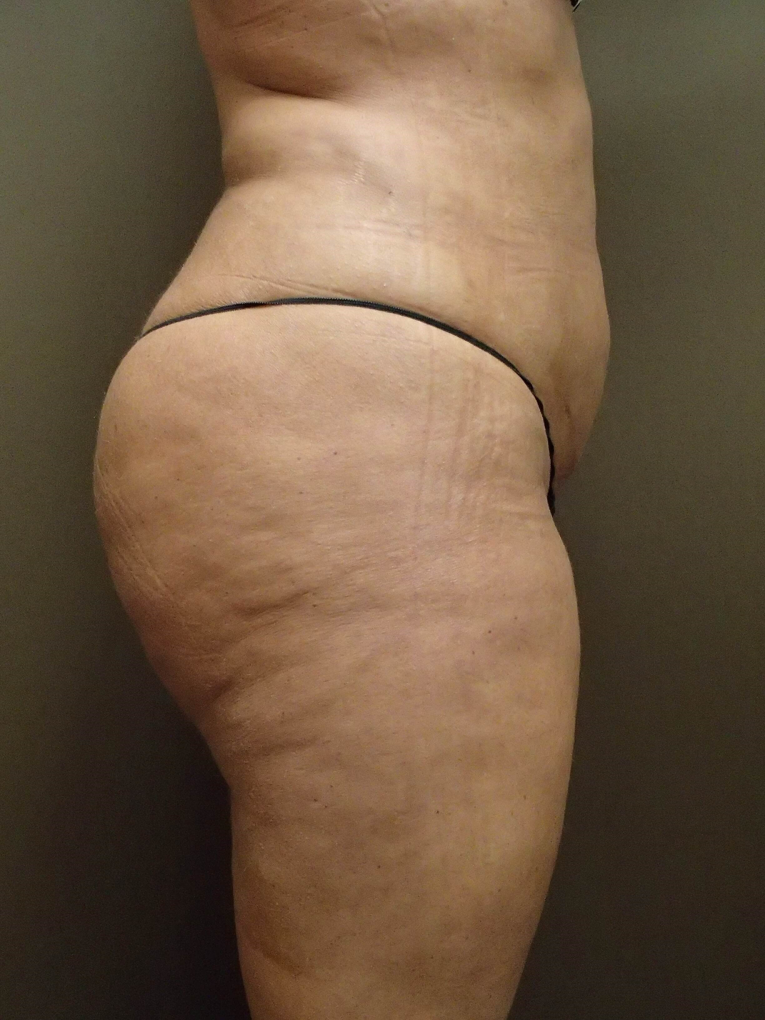 Buttock Augmentation After