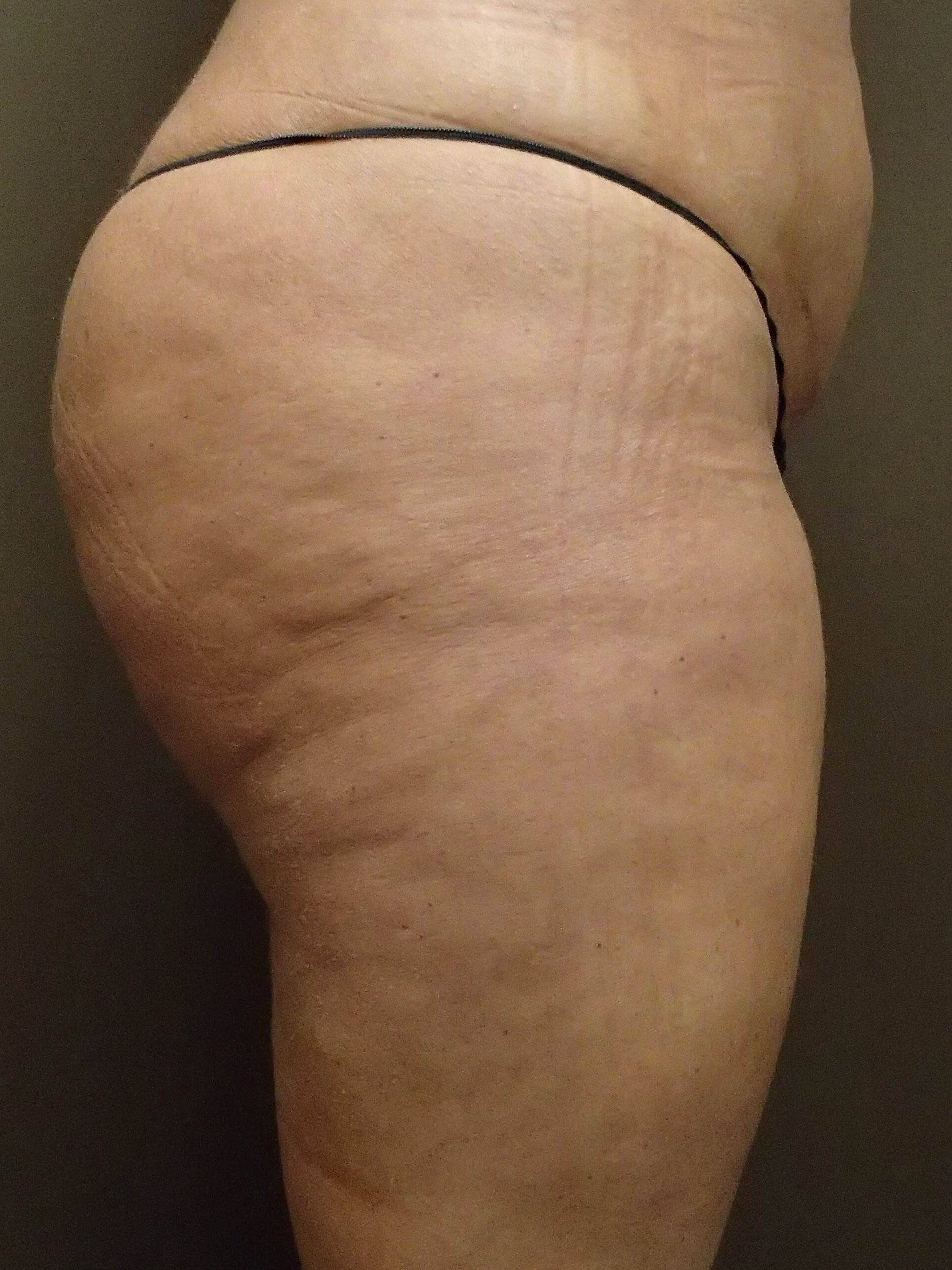 Buttock Augmentation After