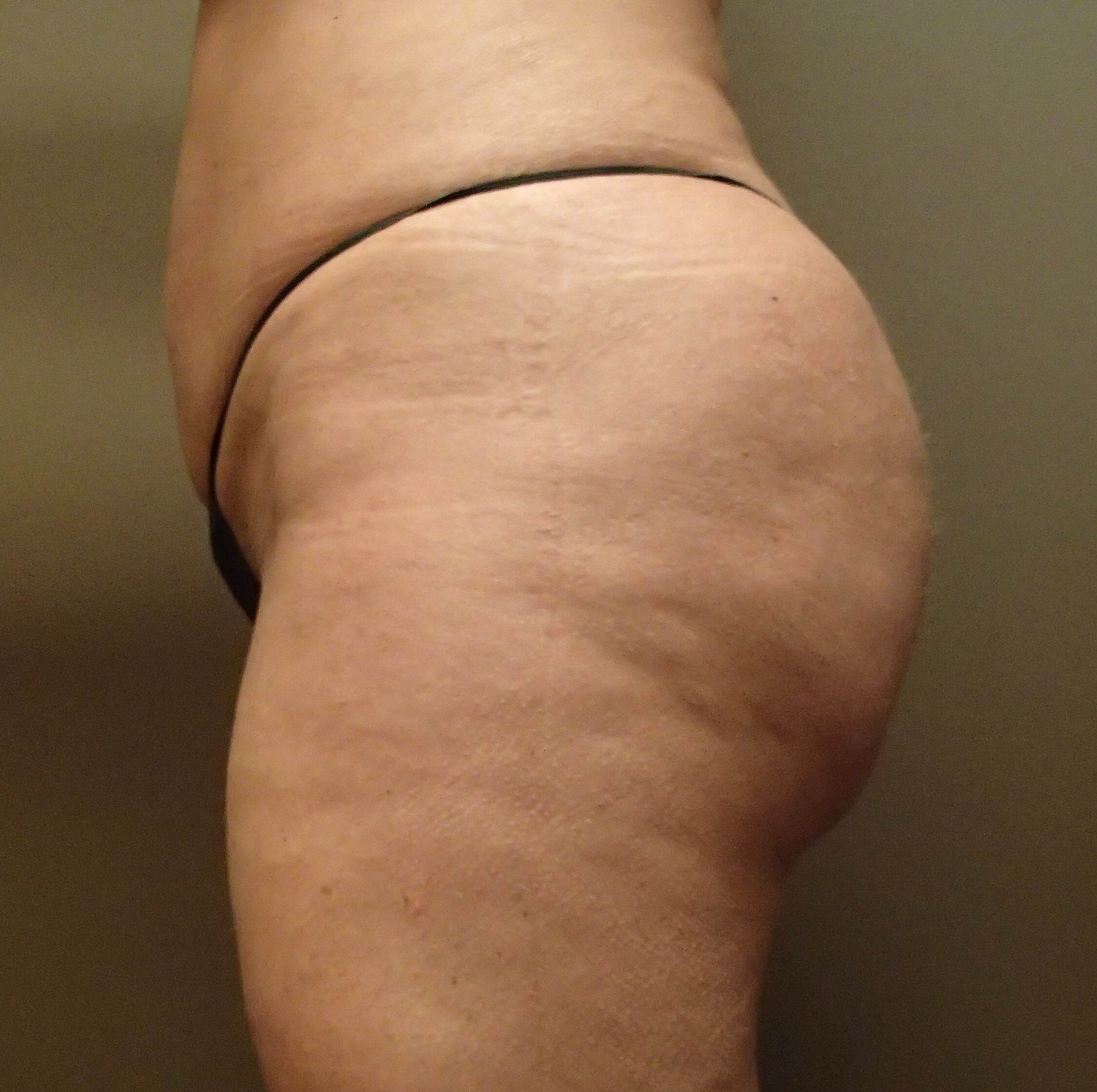Buttock Augmentation After