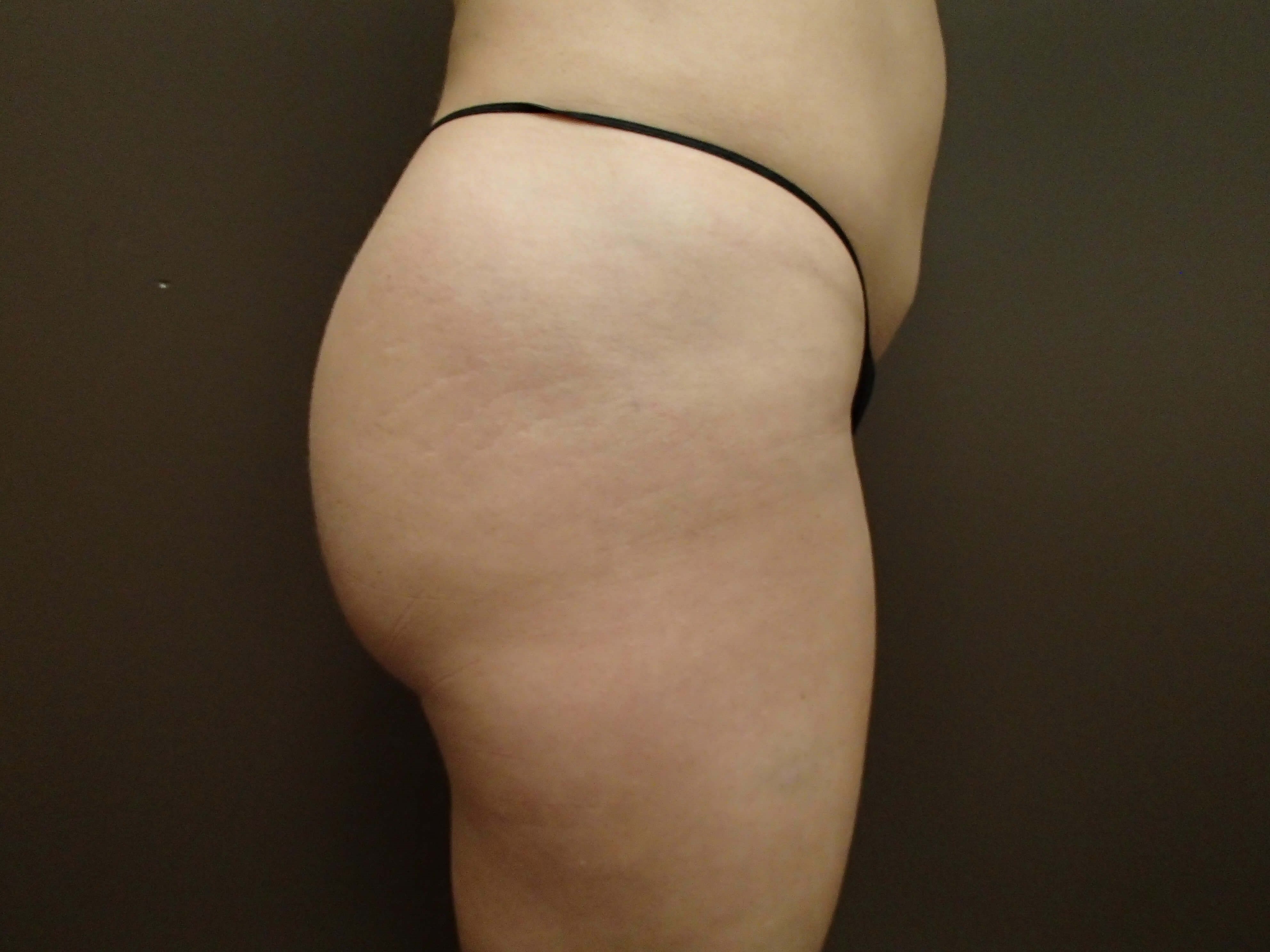 Buttock Augmentation After