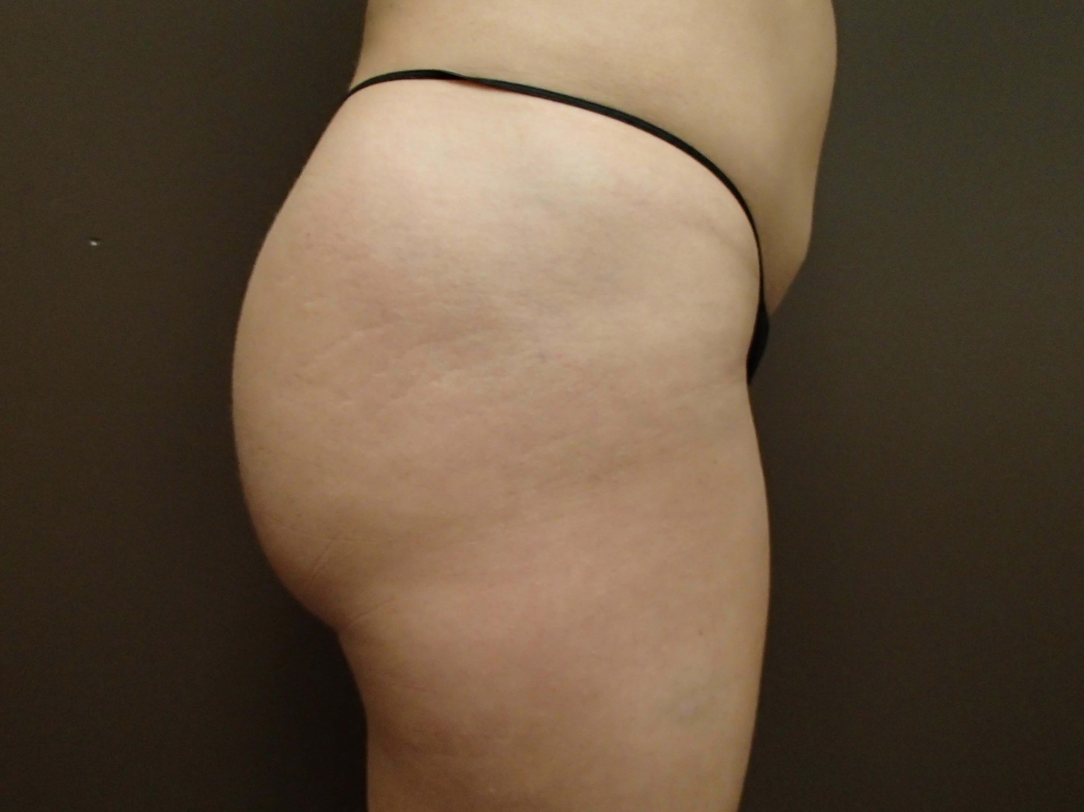 Buttock Augmentation After