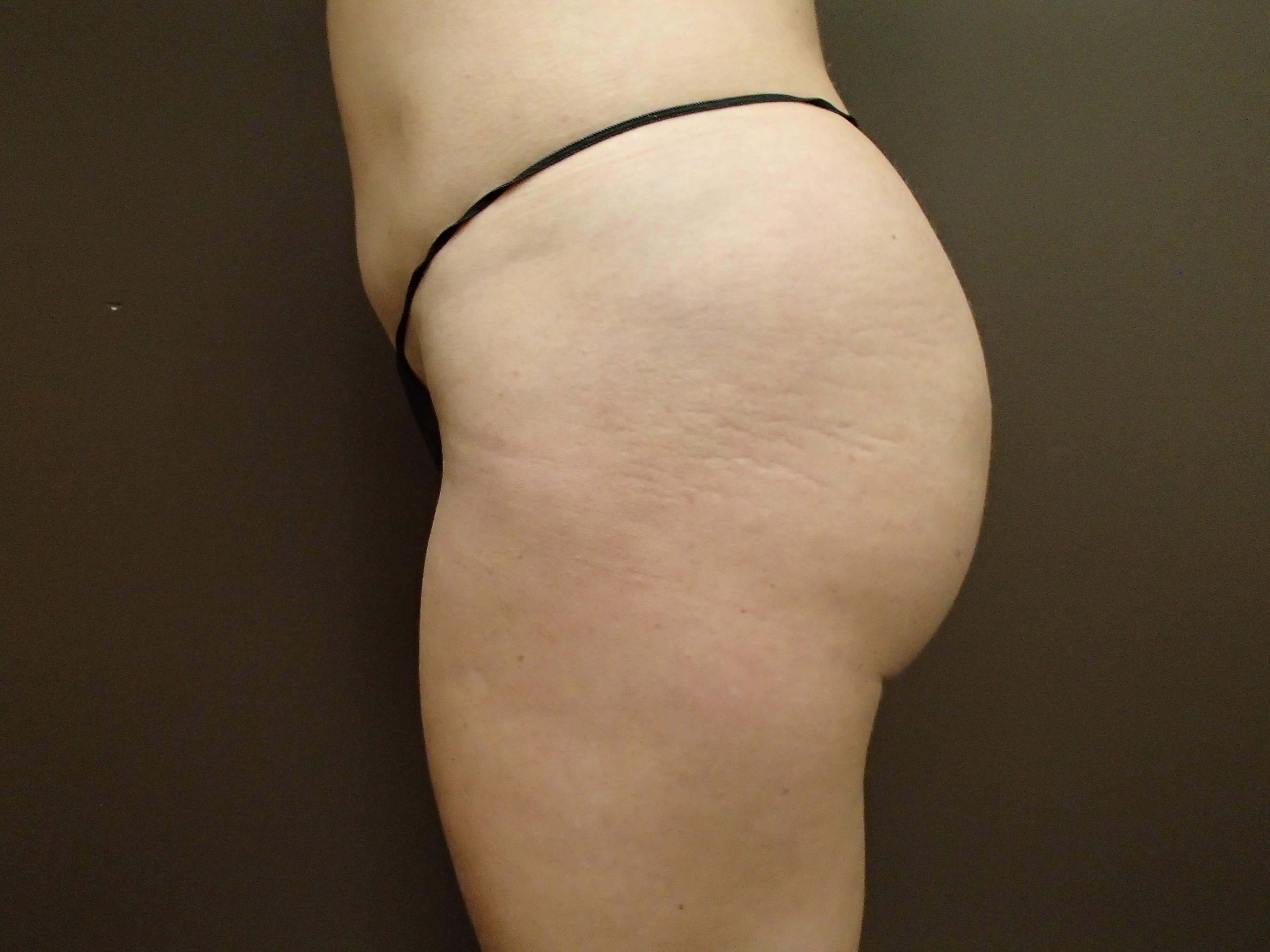 Buttock Augmentation After