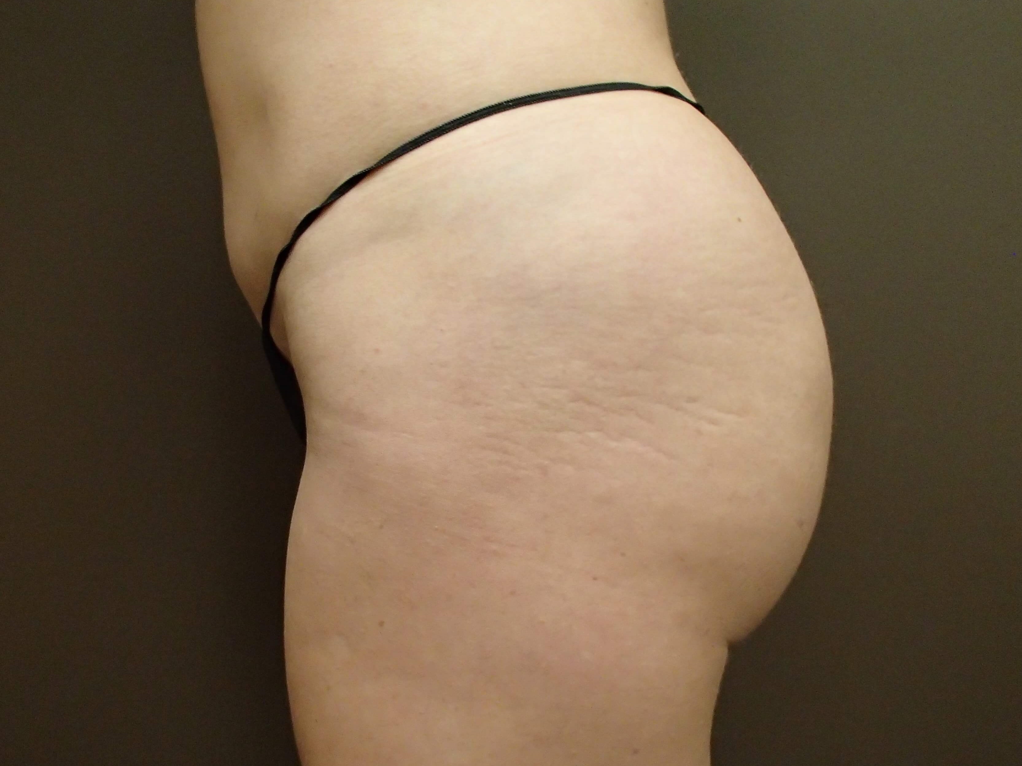 Buttock Augmentation After
