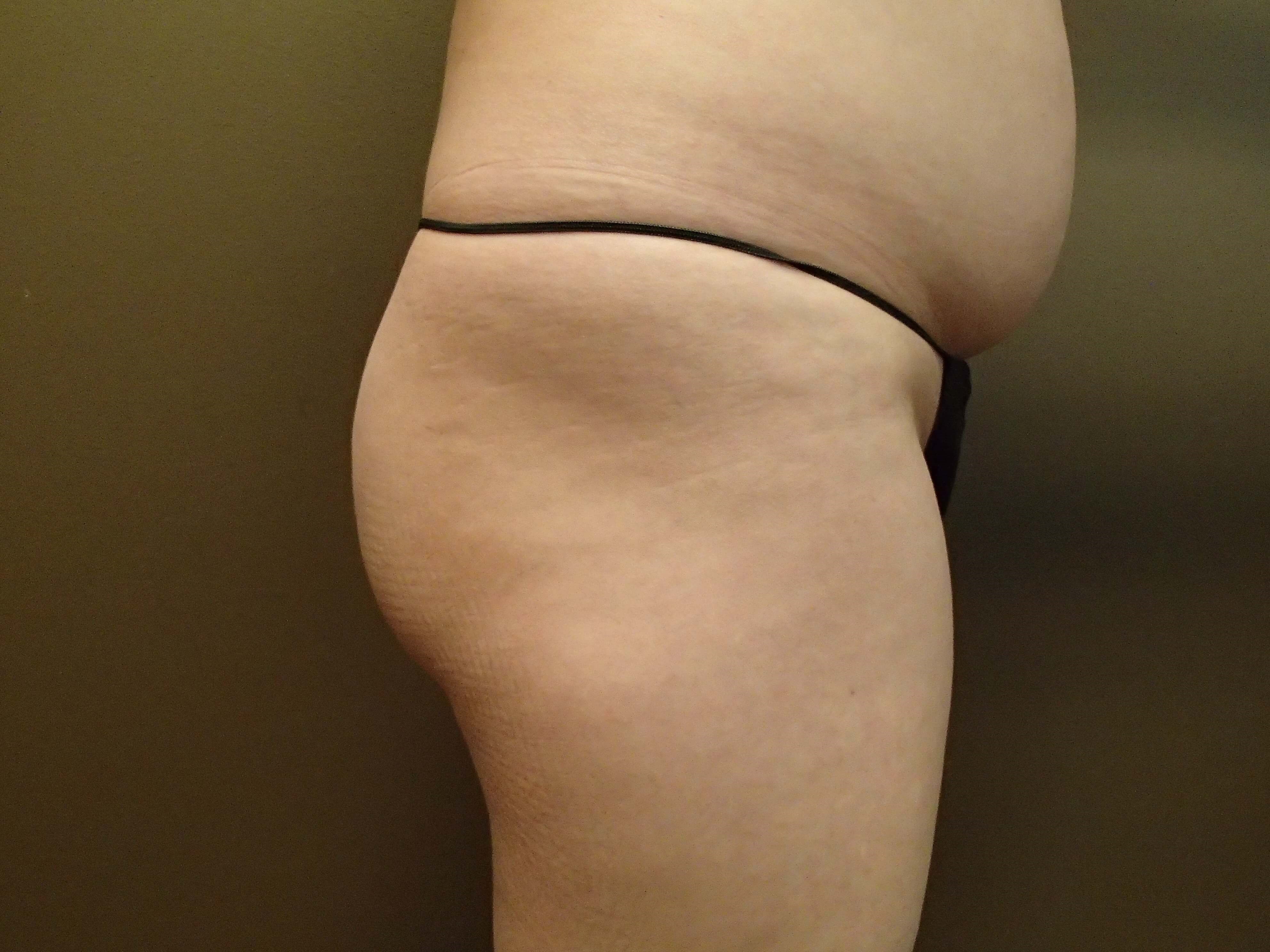 Buttock Augmentation Before