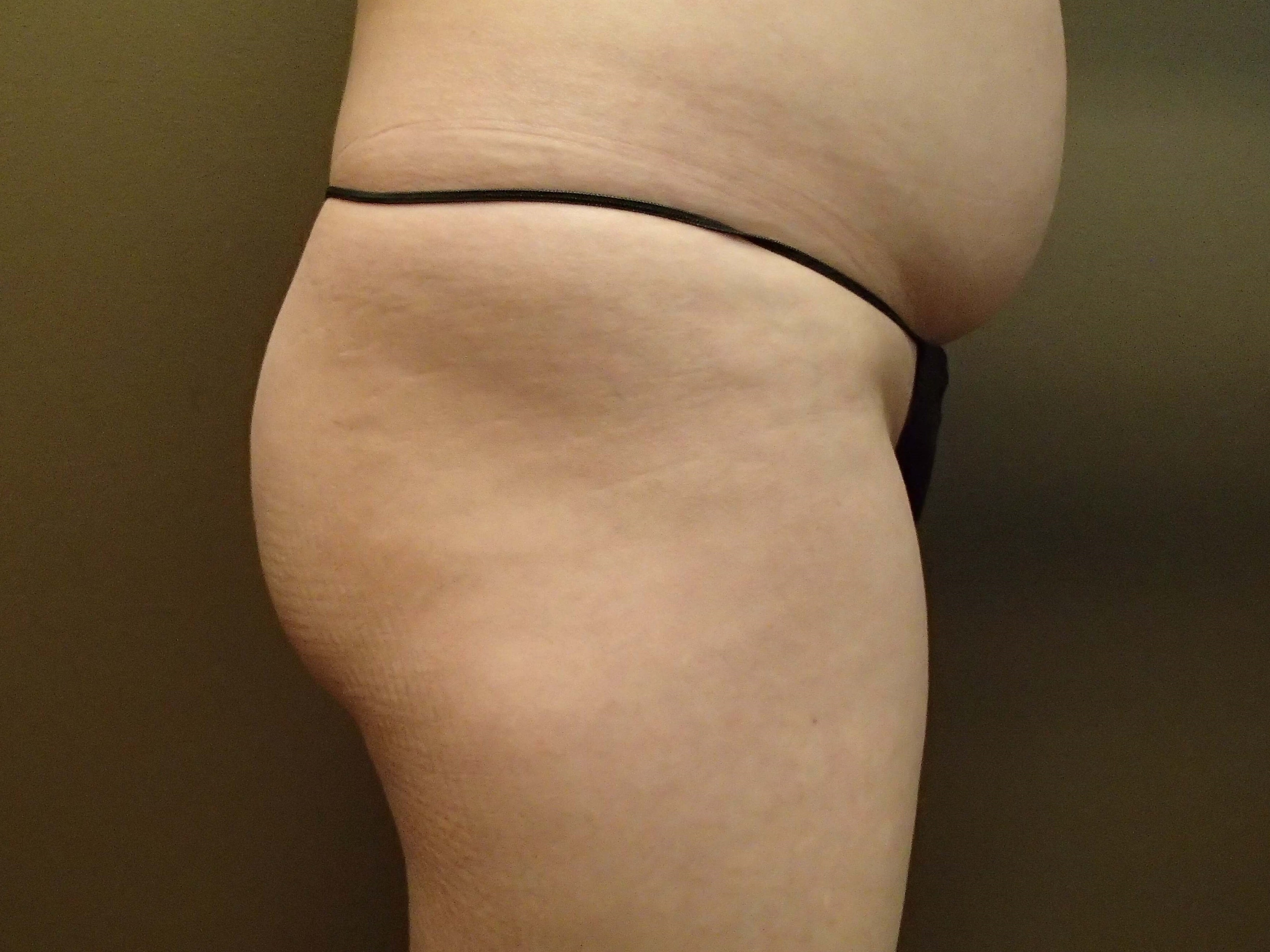 Buttock Augmentation Before