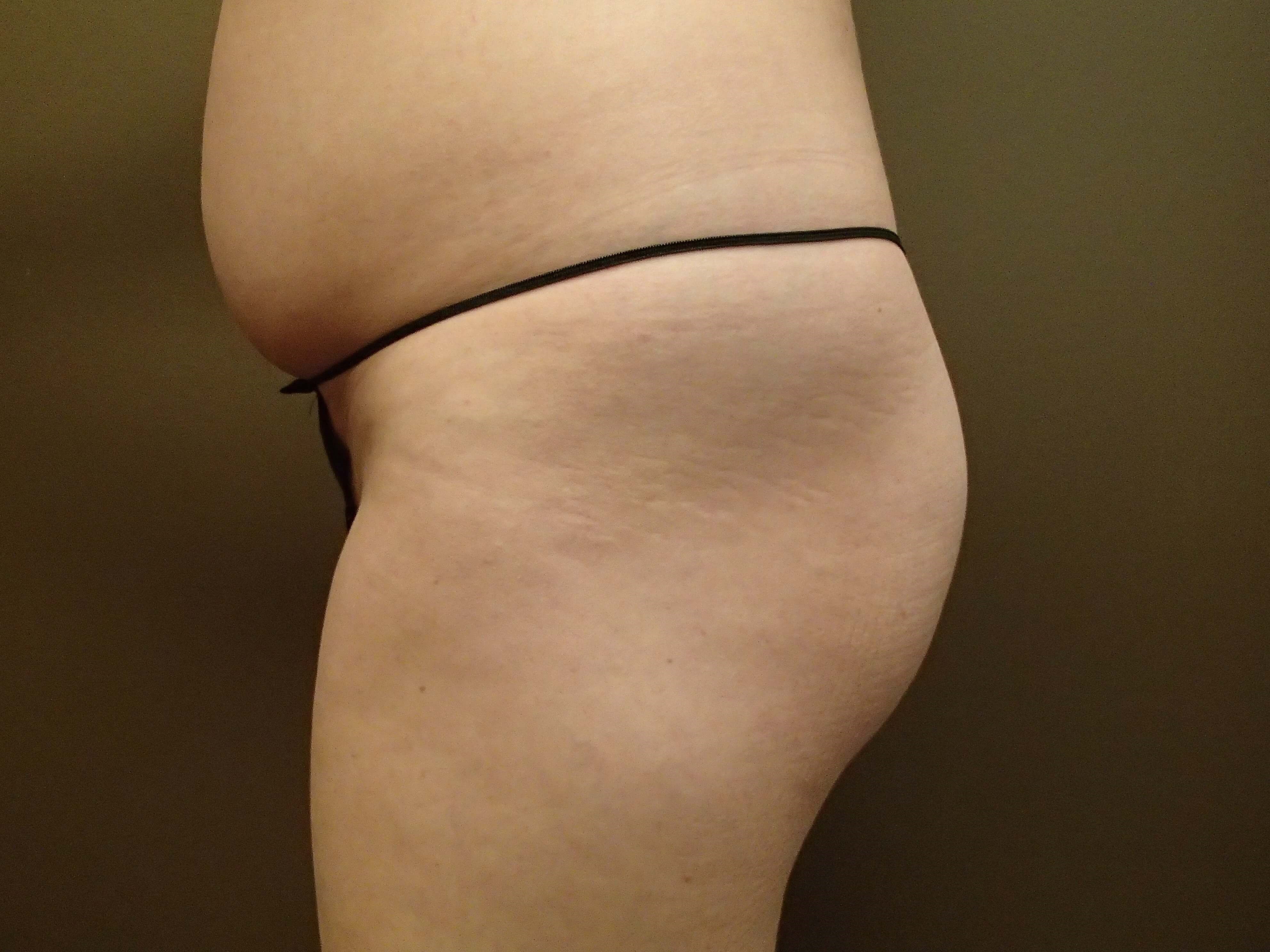 Buttock Augmentation Before