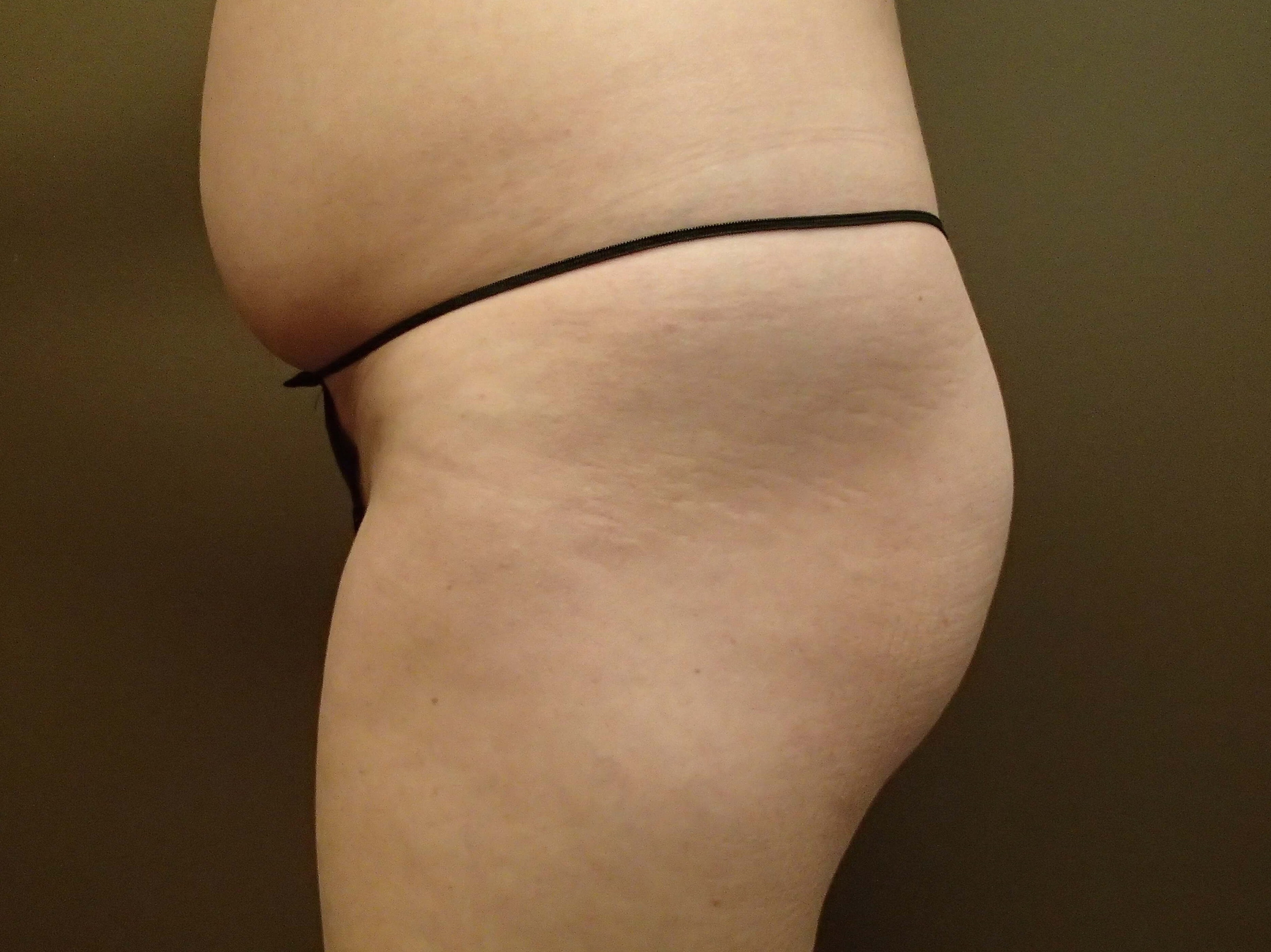 Buttock Augmentation Before