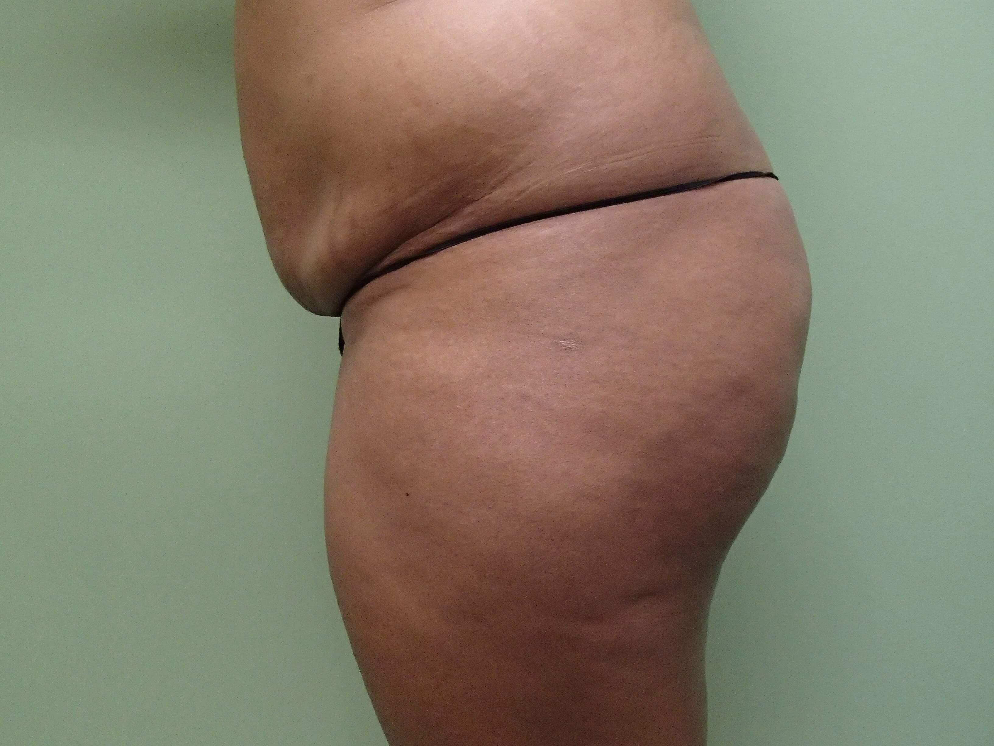 Buttock Augmentation Before