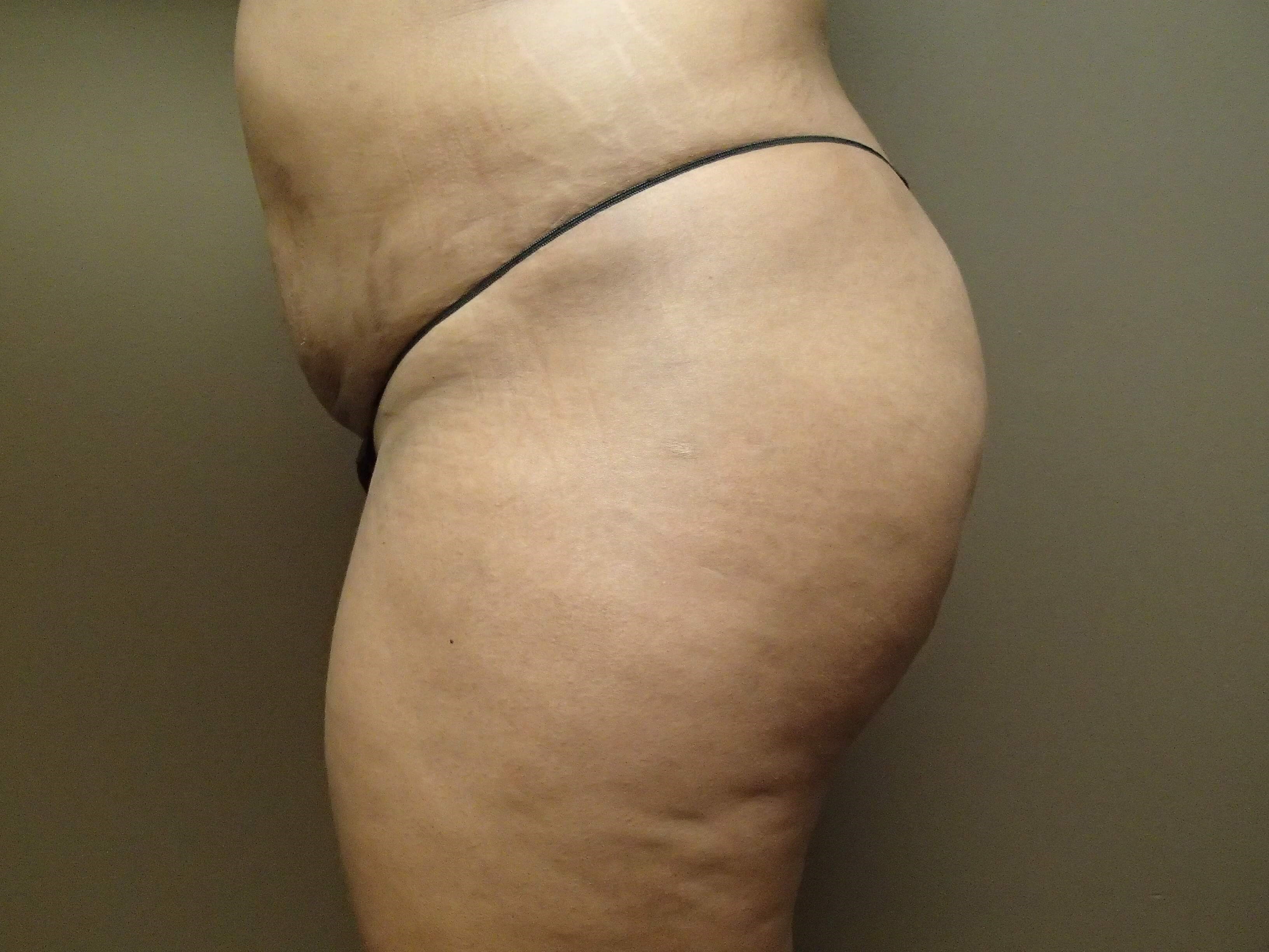 Buttock Augmentation After
