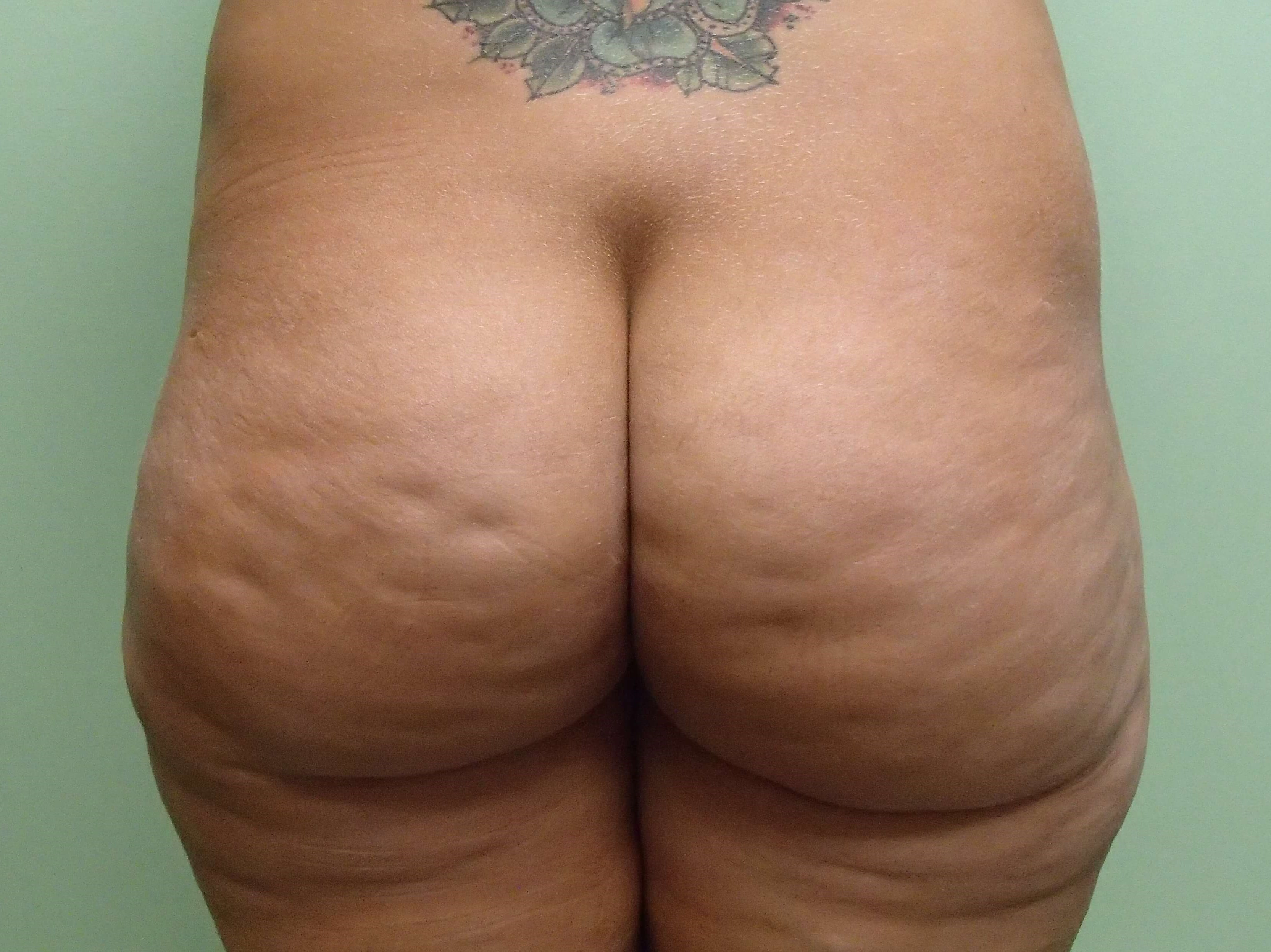 Buttock Augmentation Before