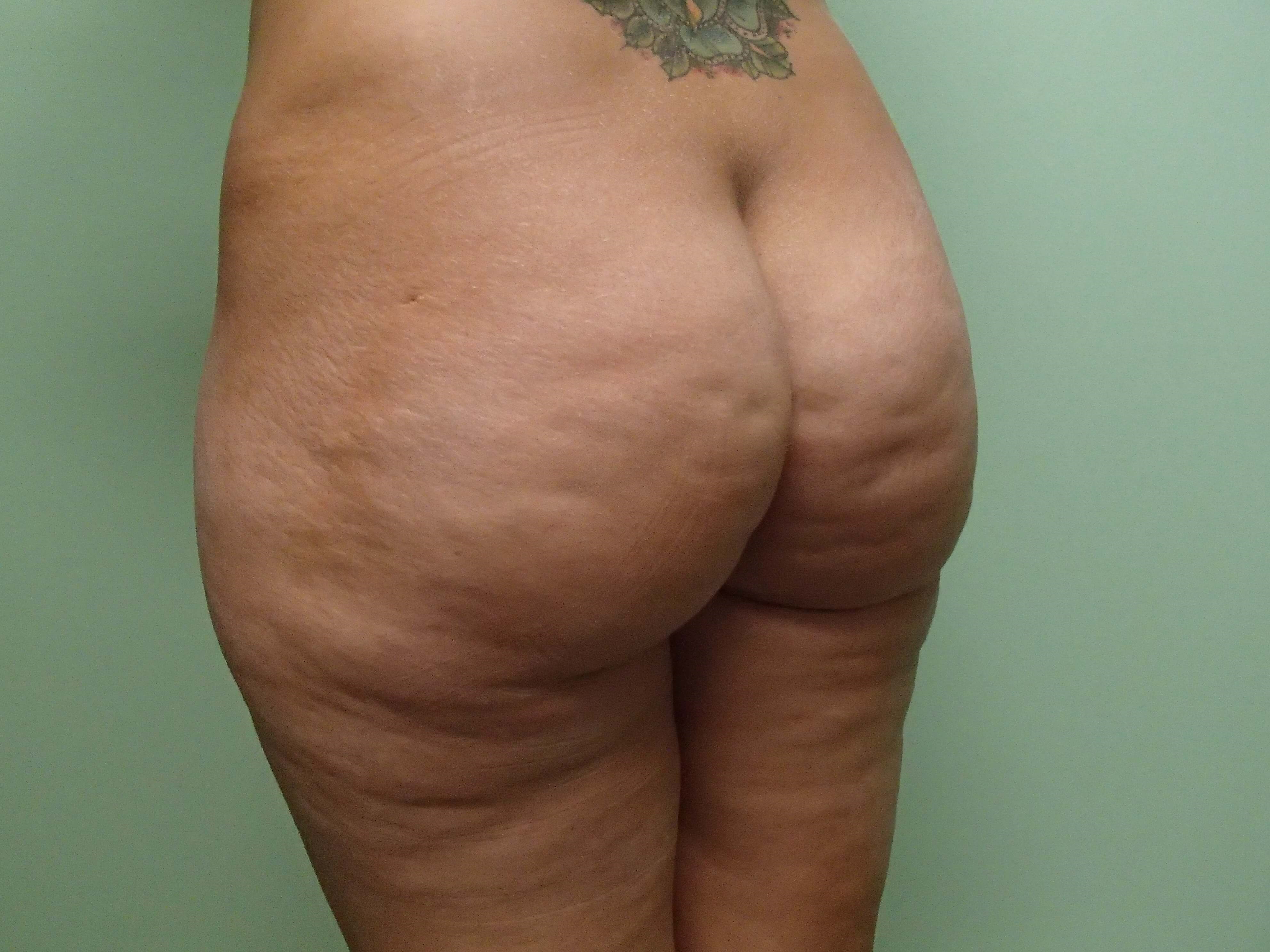 Buttock Augmentation Before