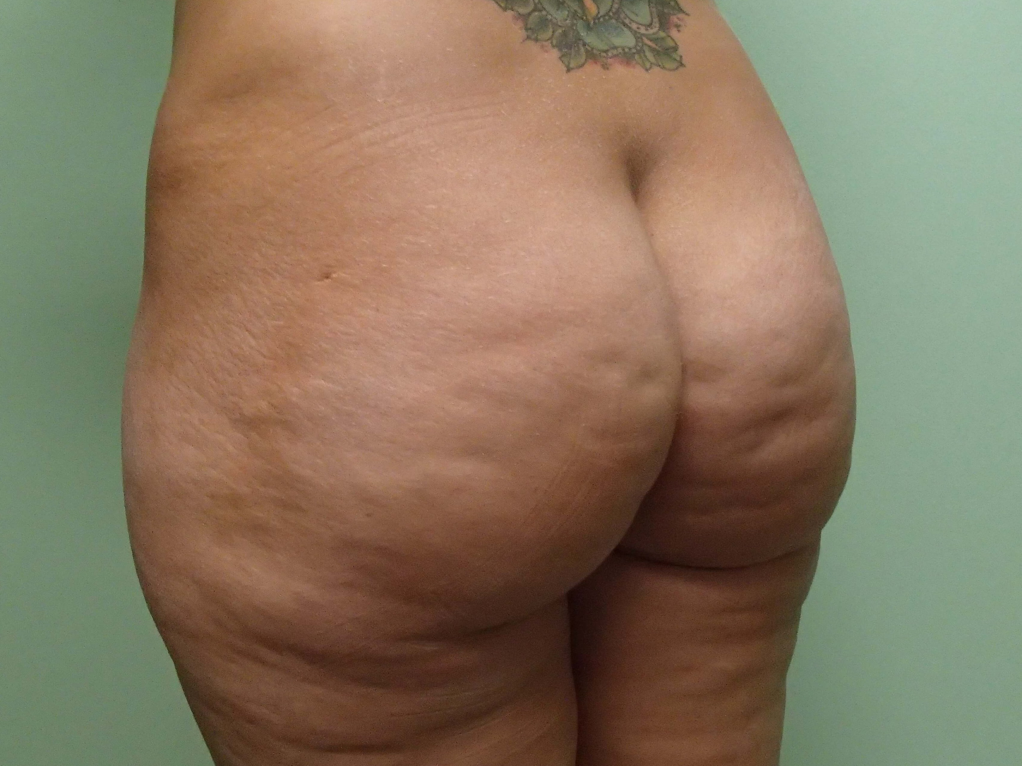 Buttock Augmentation Before