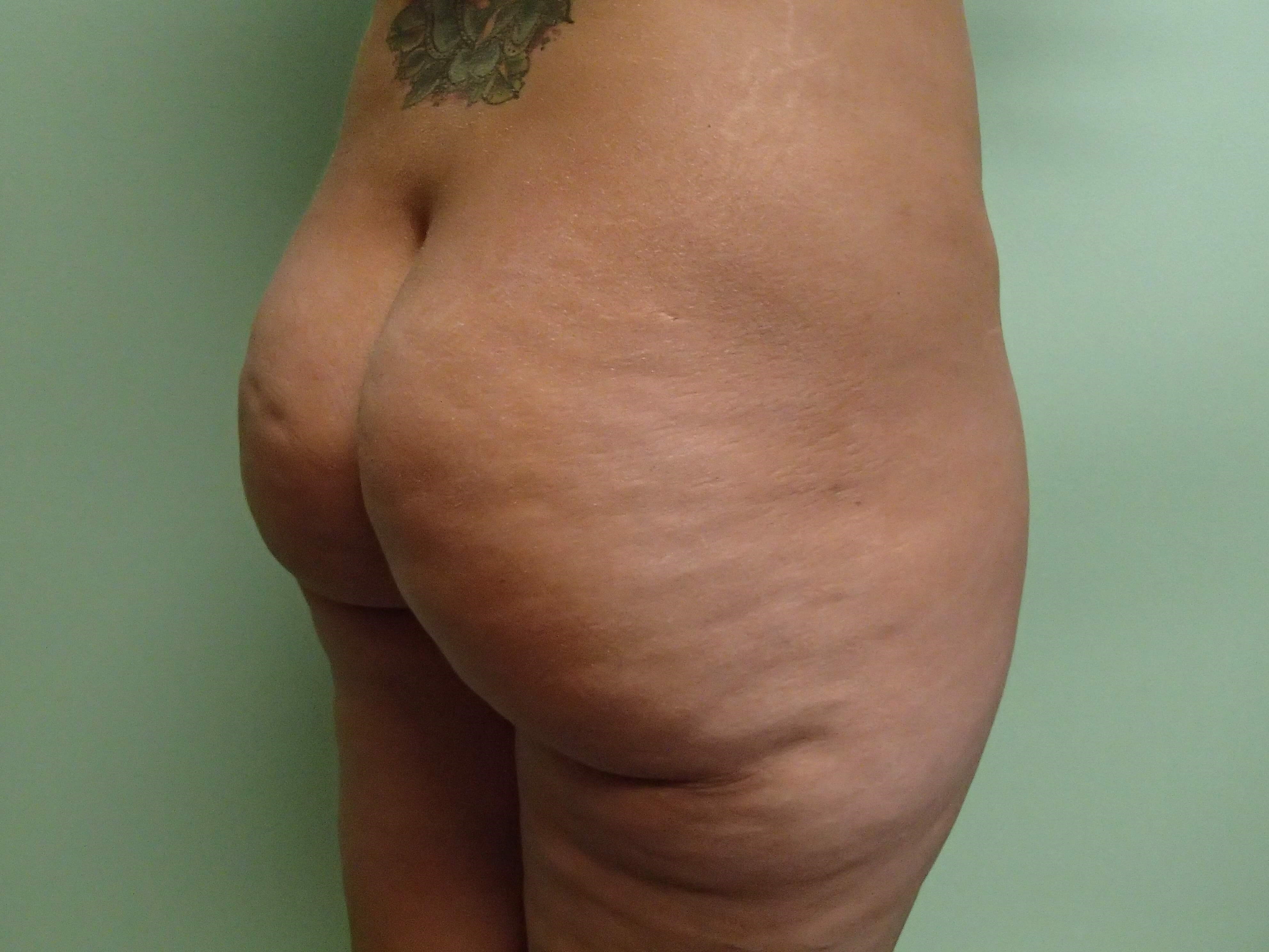 Buttock Augmentation Before
