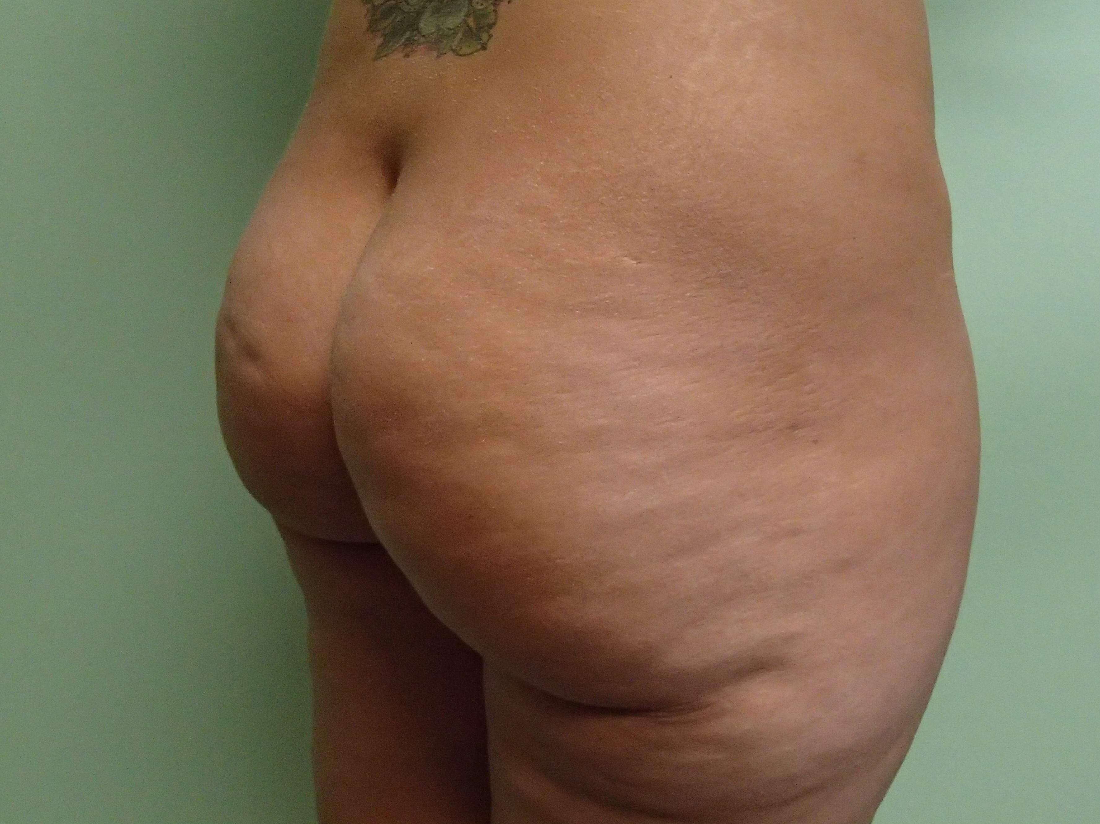Buttock Augmentation Before