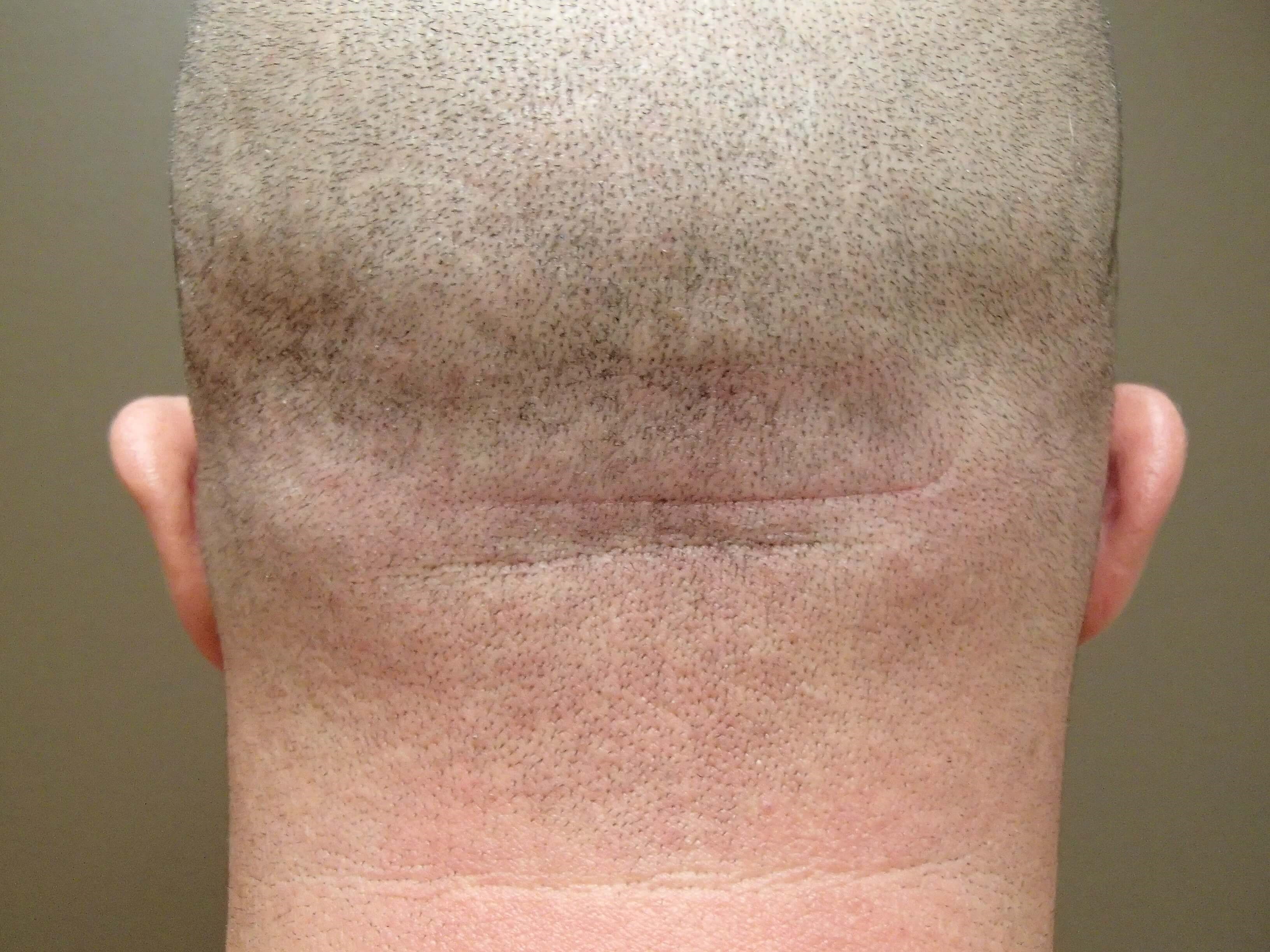 Otoplasty - Ear Surgery Before