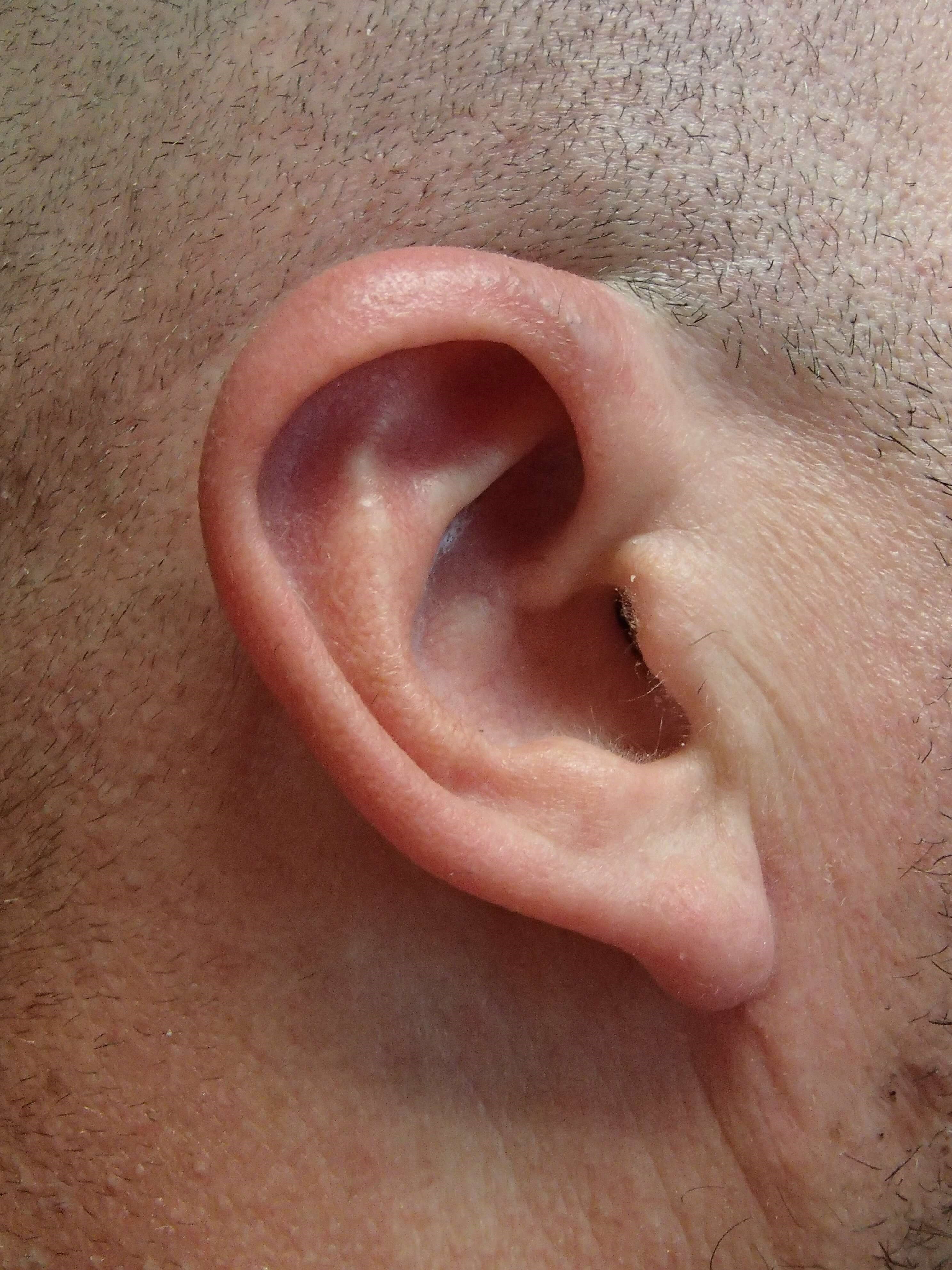 Otoplasty - Ear Surgery After