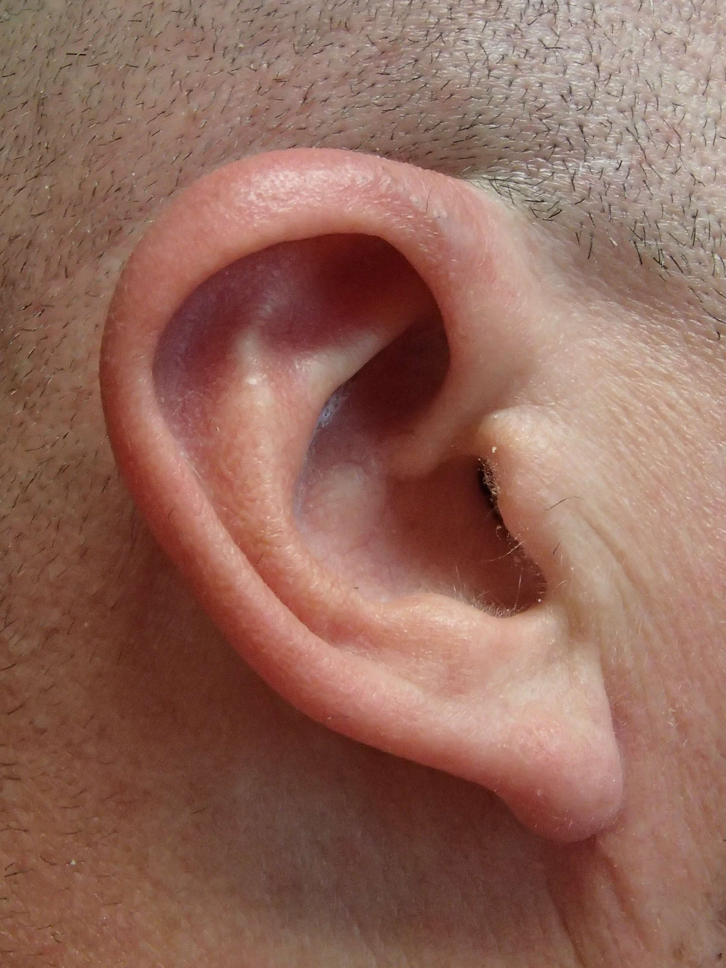 Otoplasty - Ear Surgery After