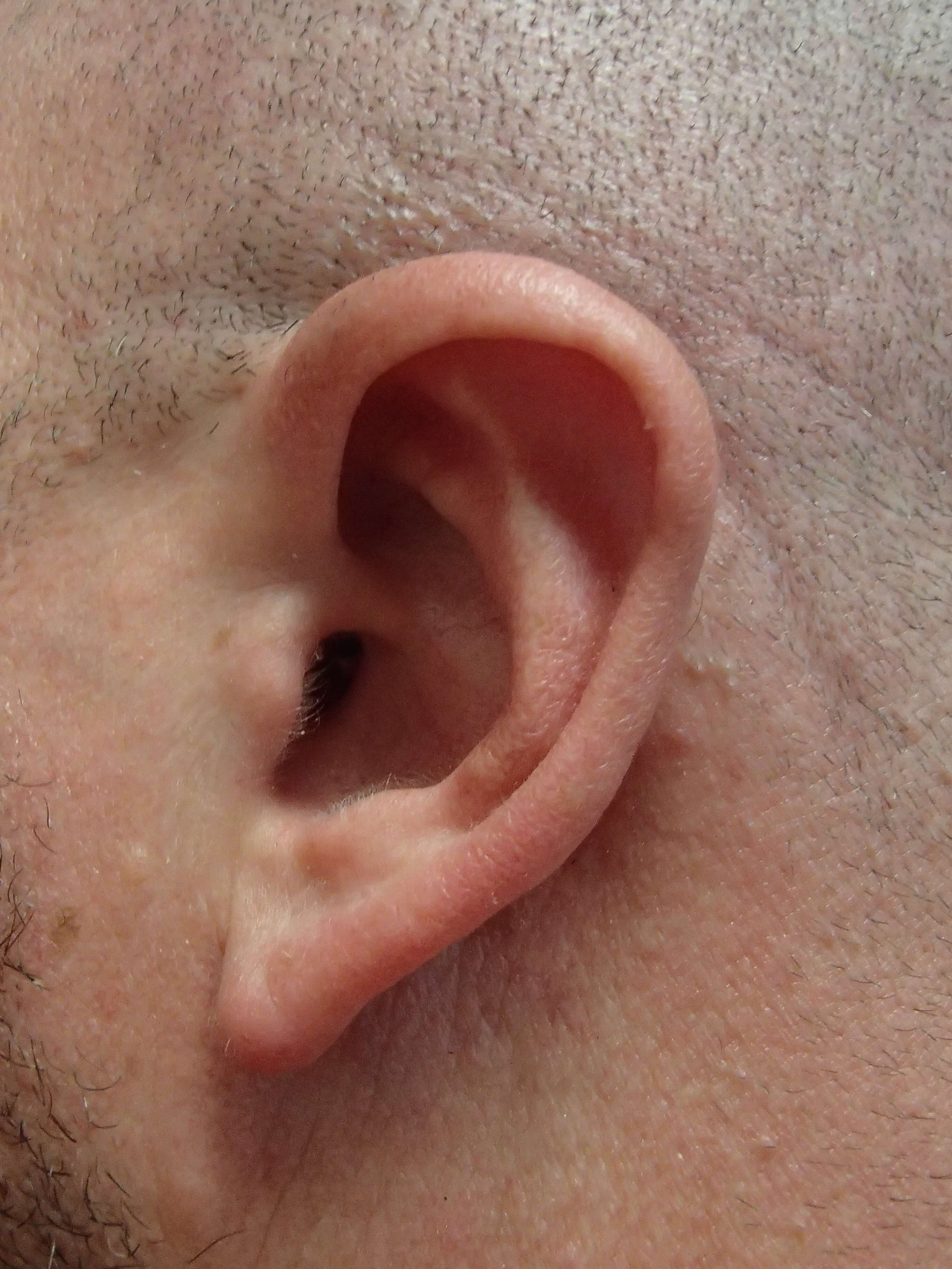 Otoplasty - Ear Surgery After