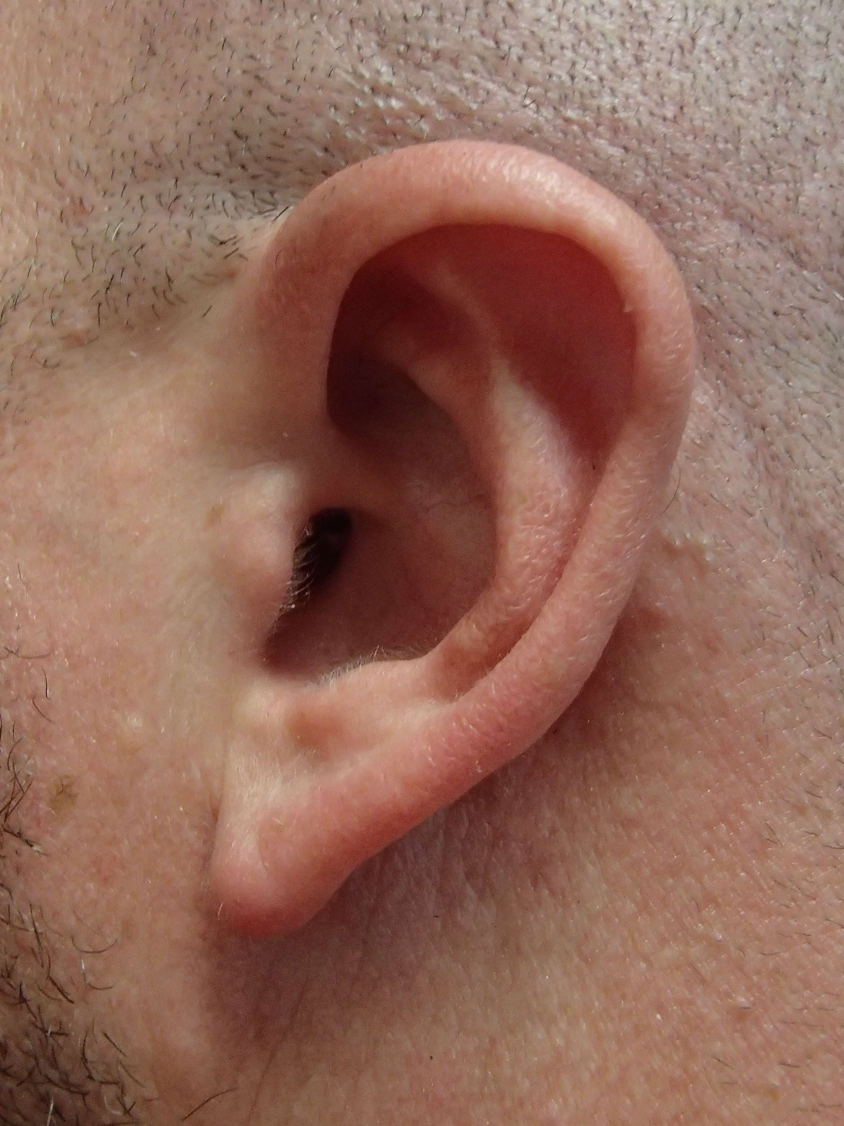 Otoplasty - Ear Surgery After