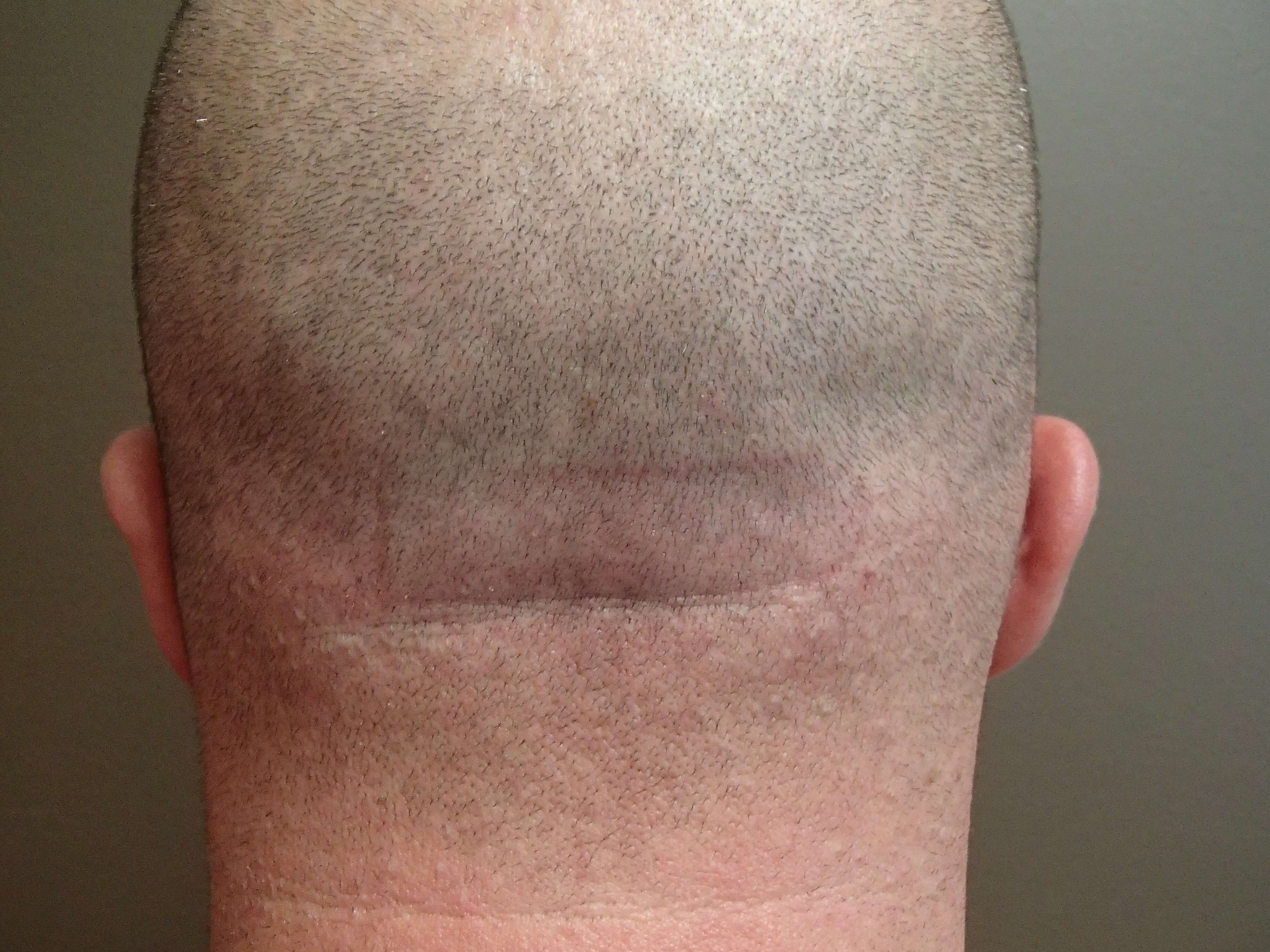 Otoplasty - Ear Surgery After
