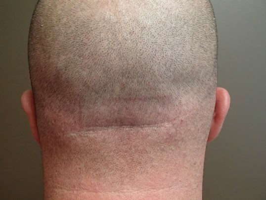 Otoplasty - Ear Surgery After