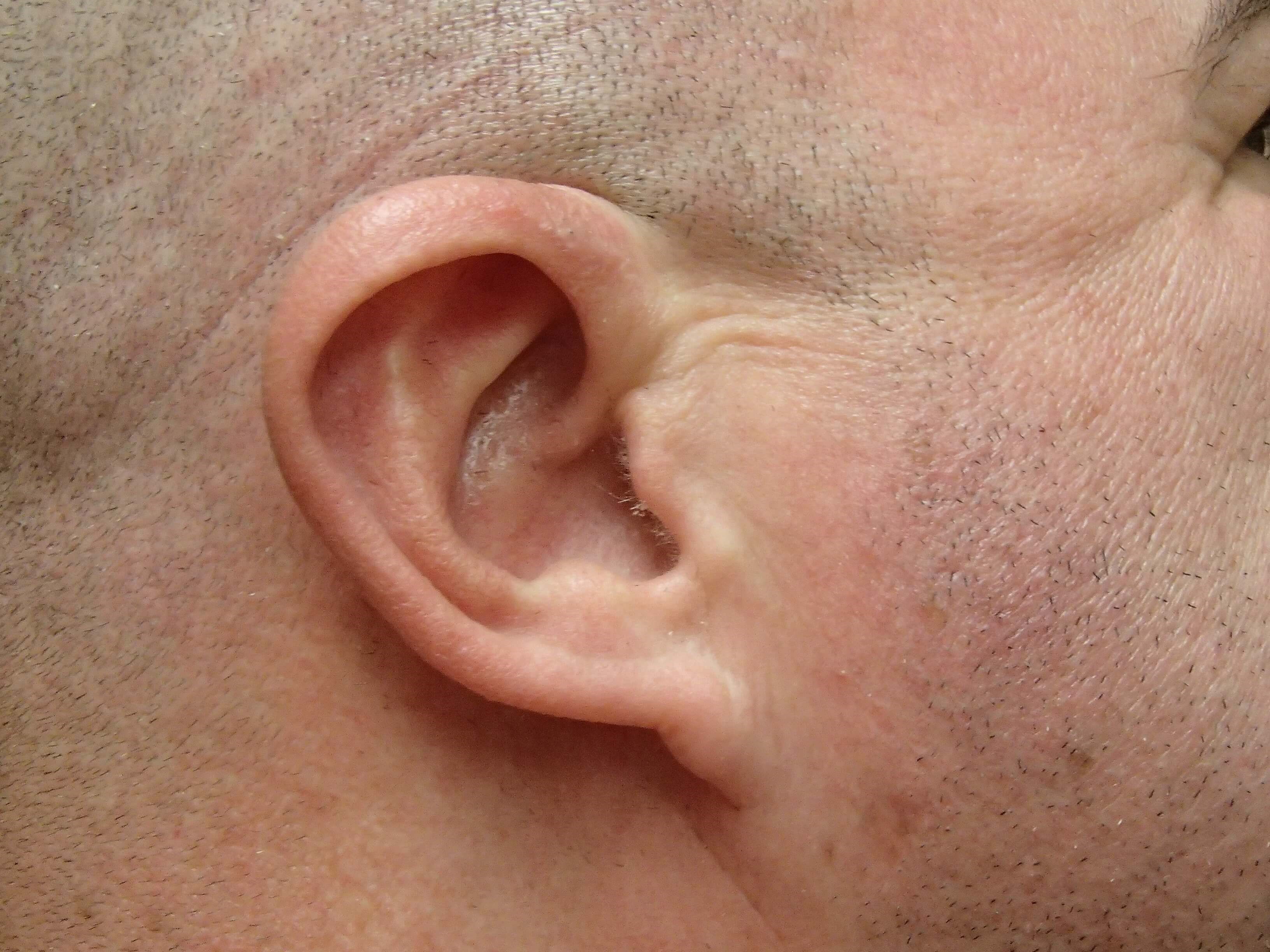 Otoplasty - Ear Surgery Before