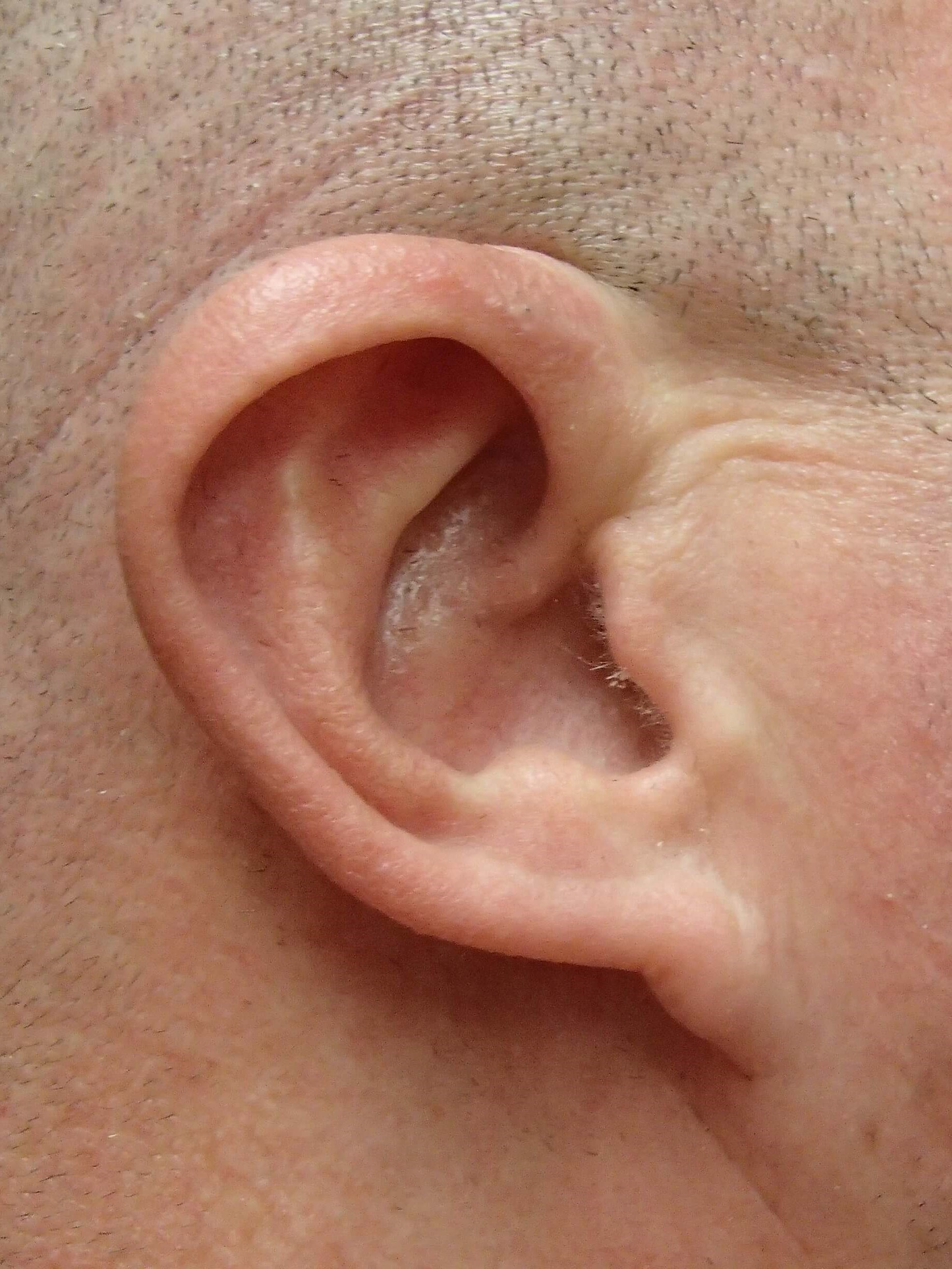 Otoplasty - Ear Surgery Before
