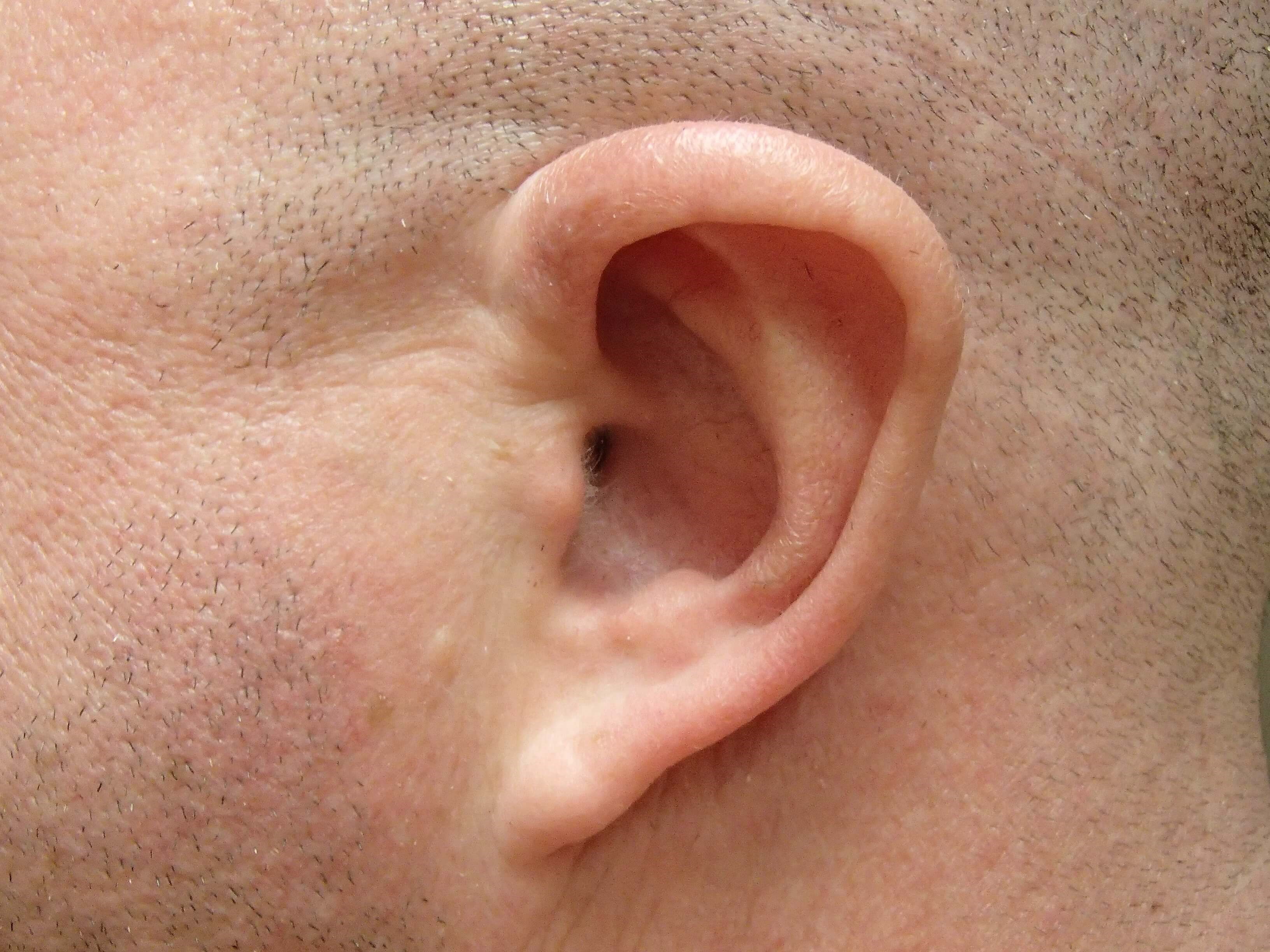 Otoplasty - Ear Surgery Before