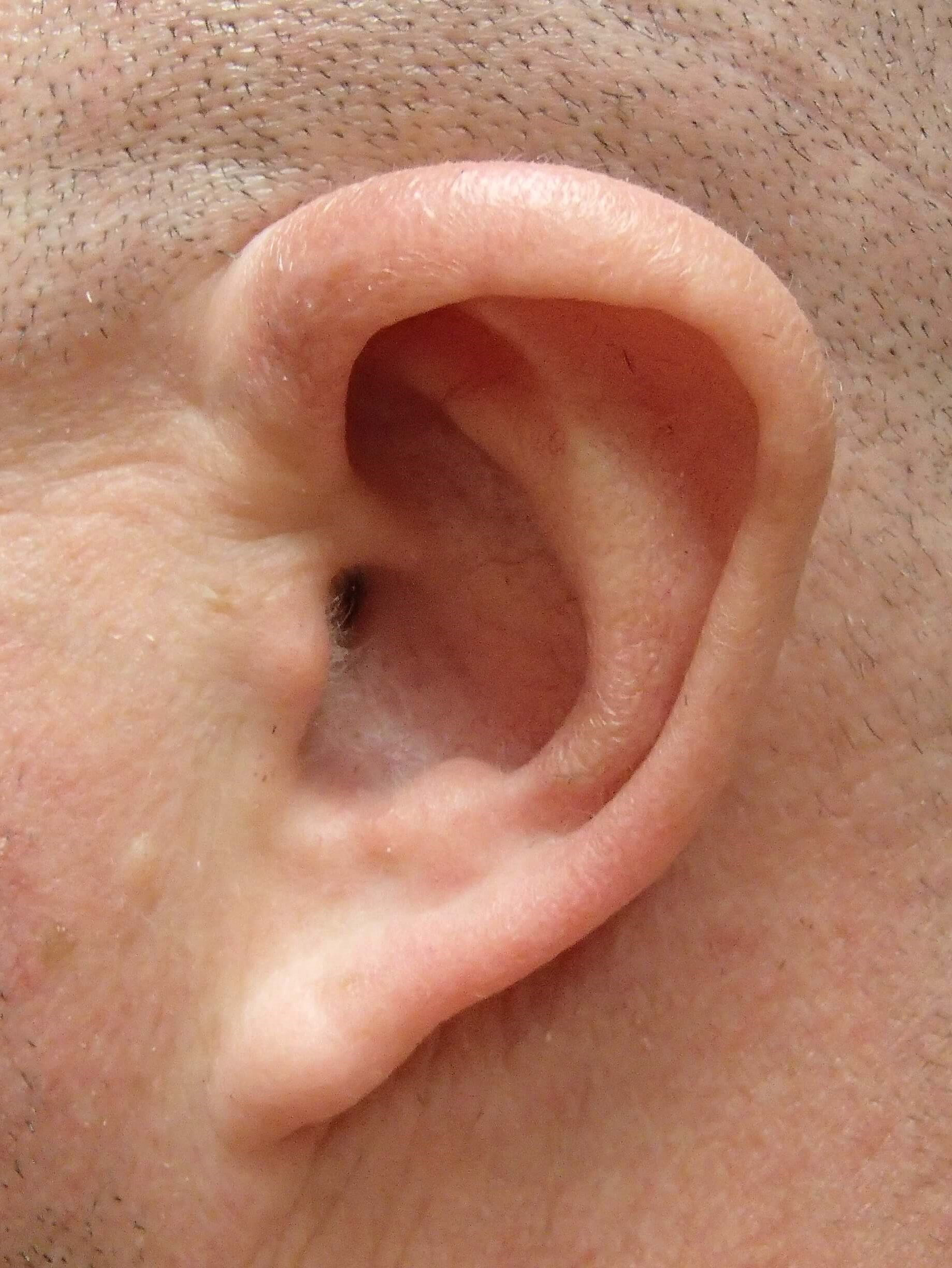 Otoplasty - Ear Surgery Before