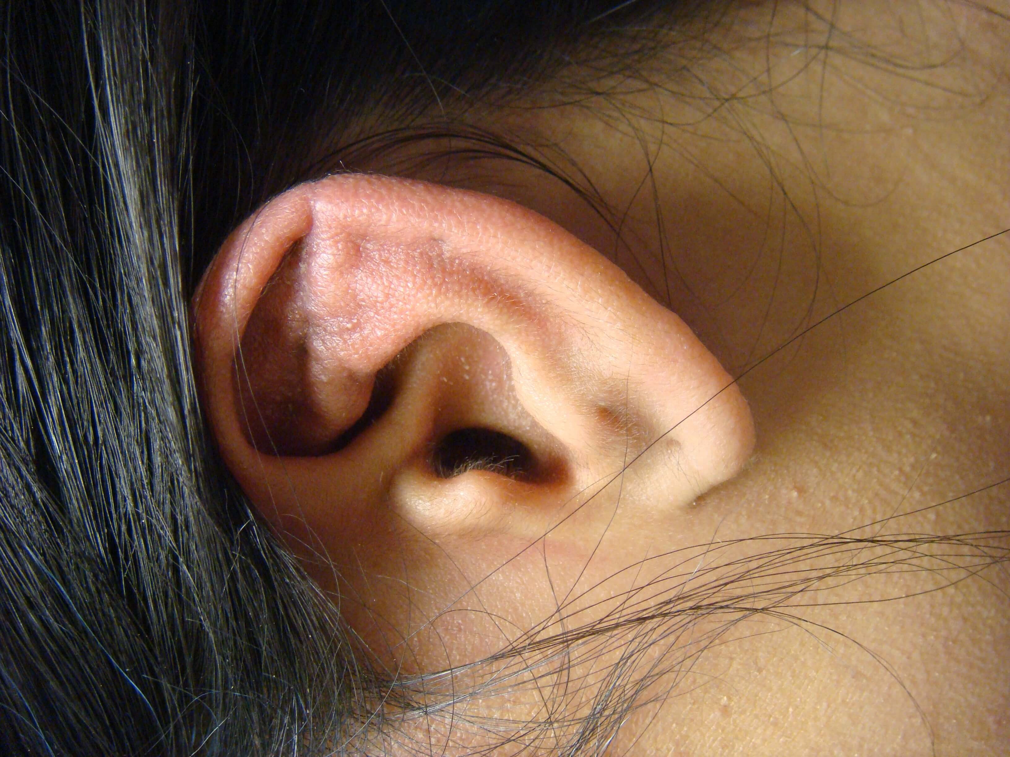 Otoplasty - Ear Surgery After