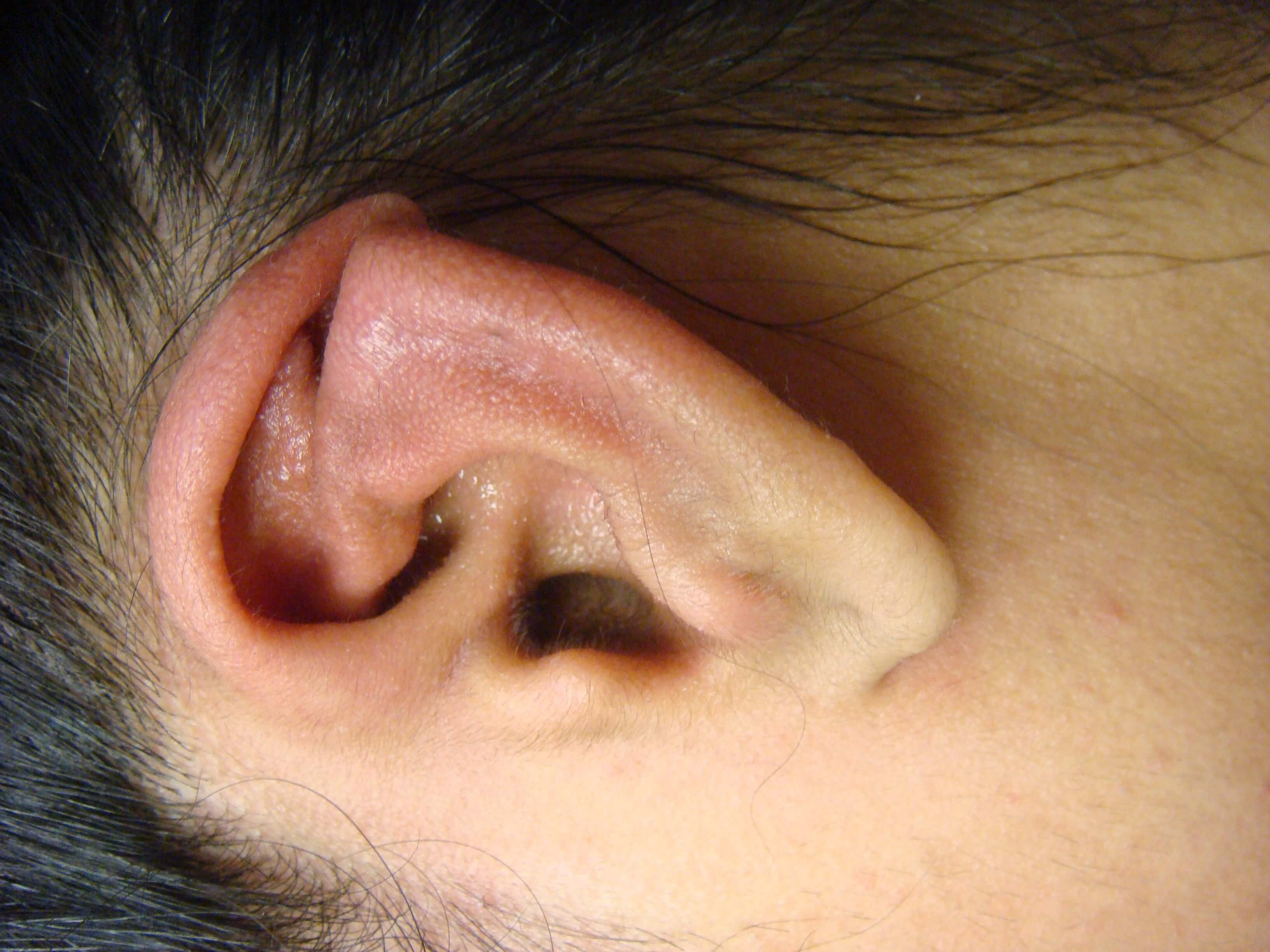 Otoplasty - Ear Surgery Before