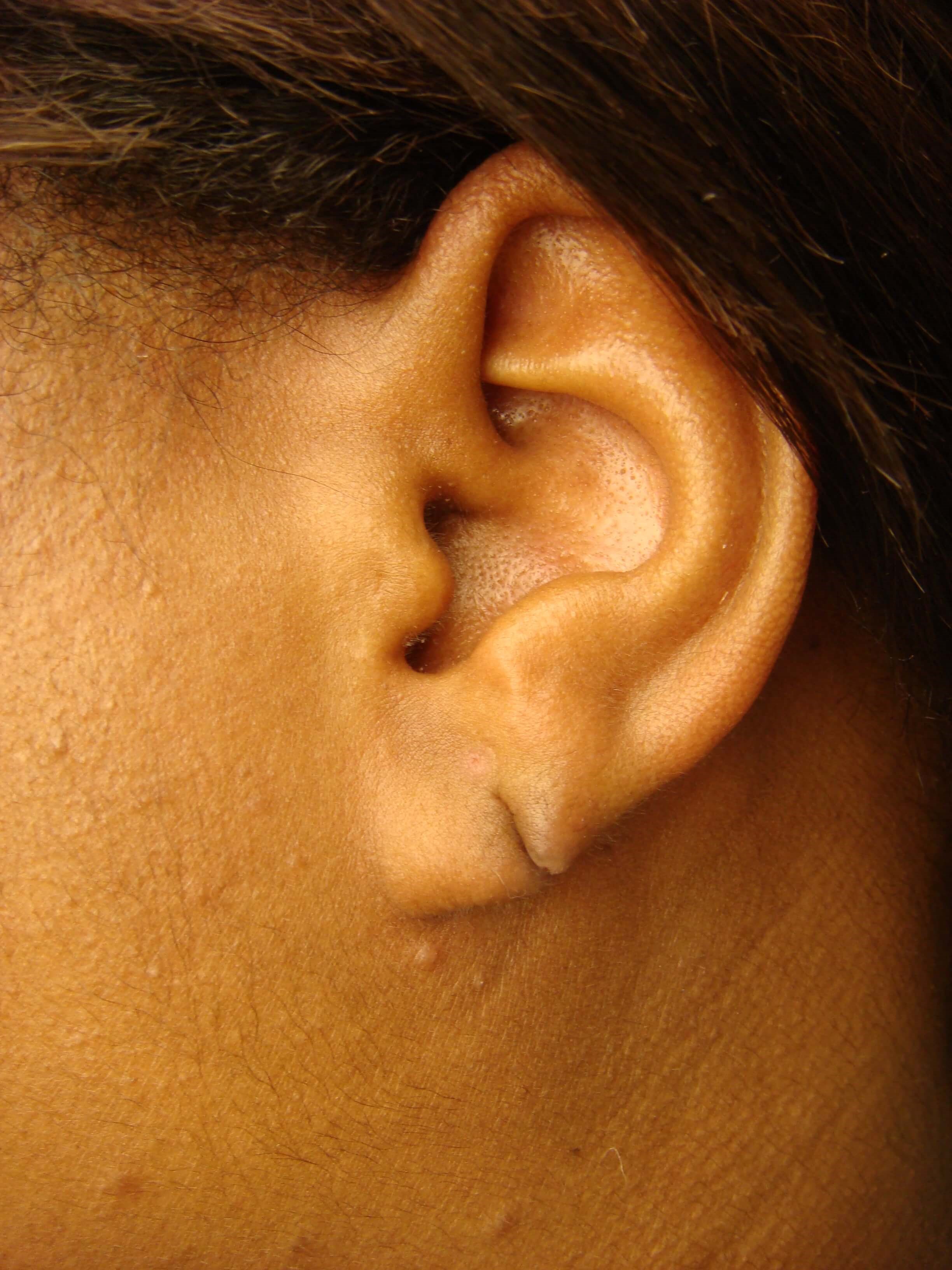Earlobe Repair Before